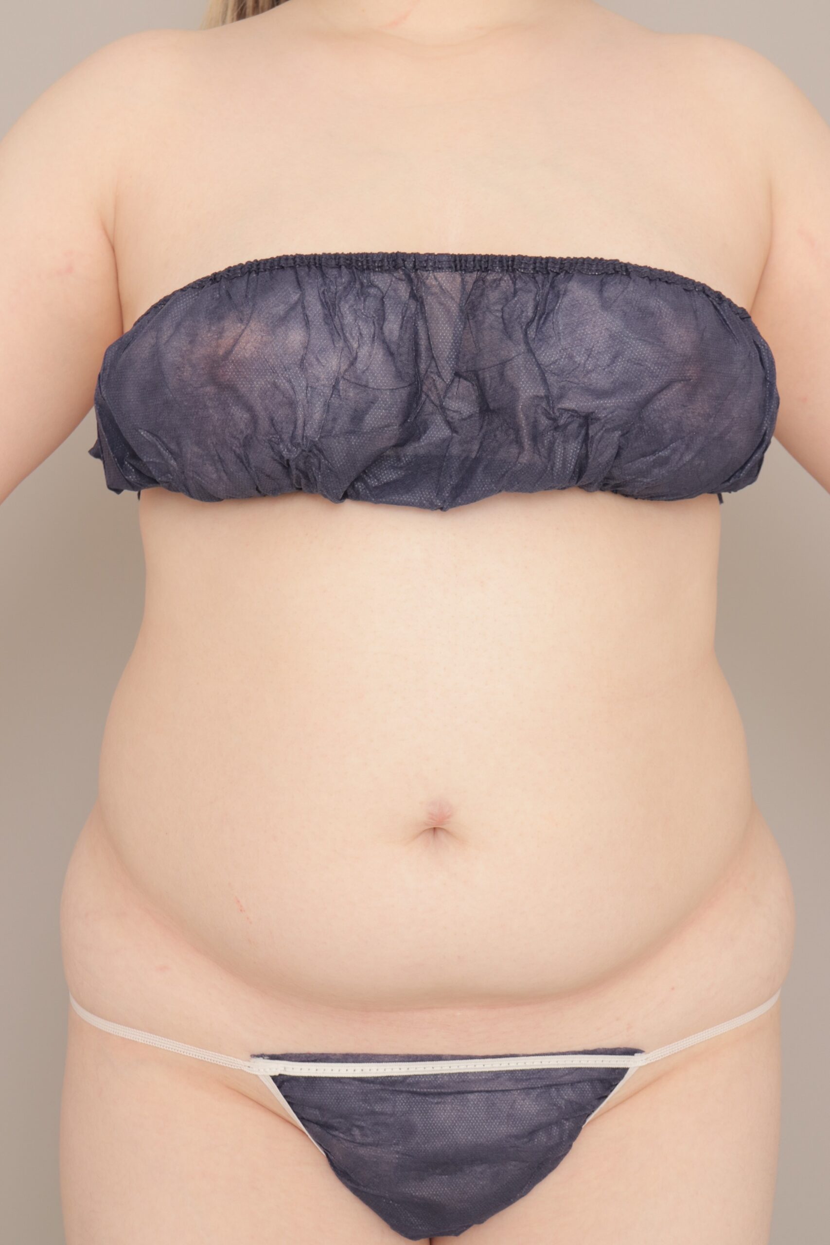 ベイザー脂肪吸引(1か月経過:20)の術前写真