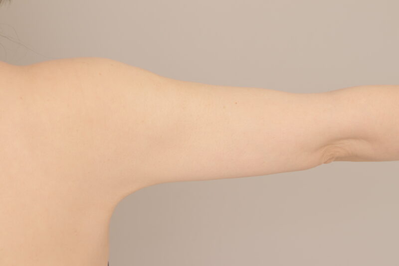 ベイザー脂肪吸引(2ヶ月経過:51)の術後写真