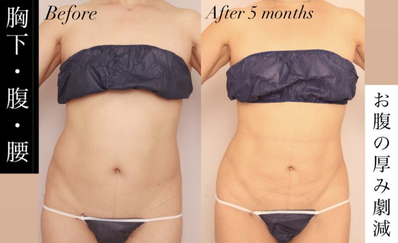【胸下の脂肪が消えた】お腹の厚みが劇的に薄くなり、フラットなお腹に