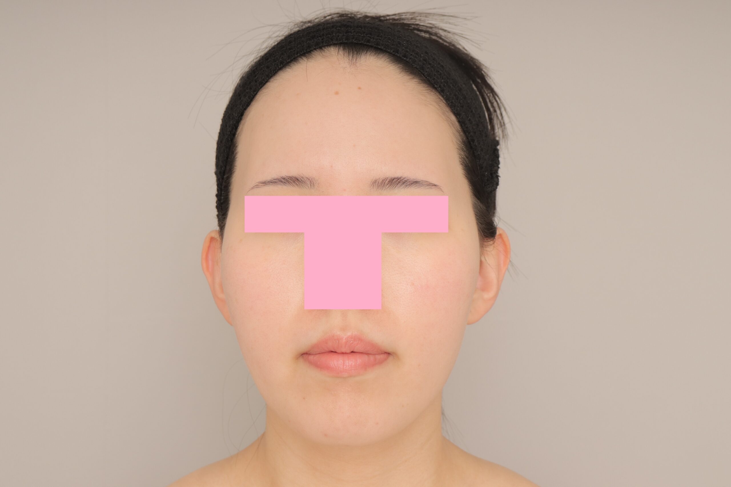 ベイザー脂肪吸引（6ヵ月経過：29）の術後写真