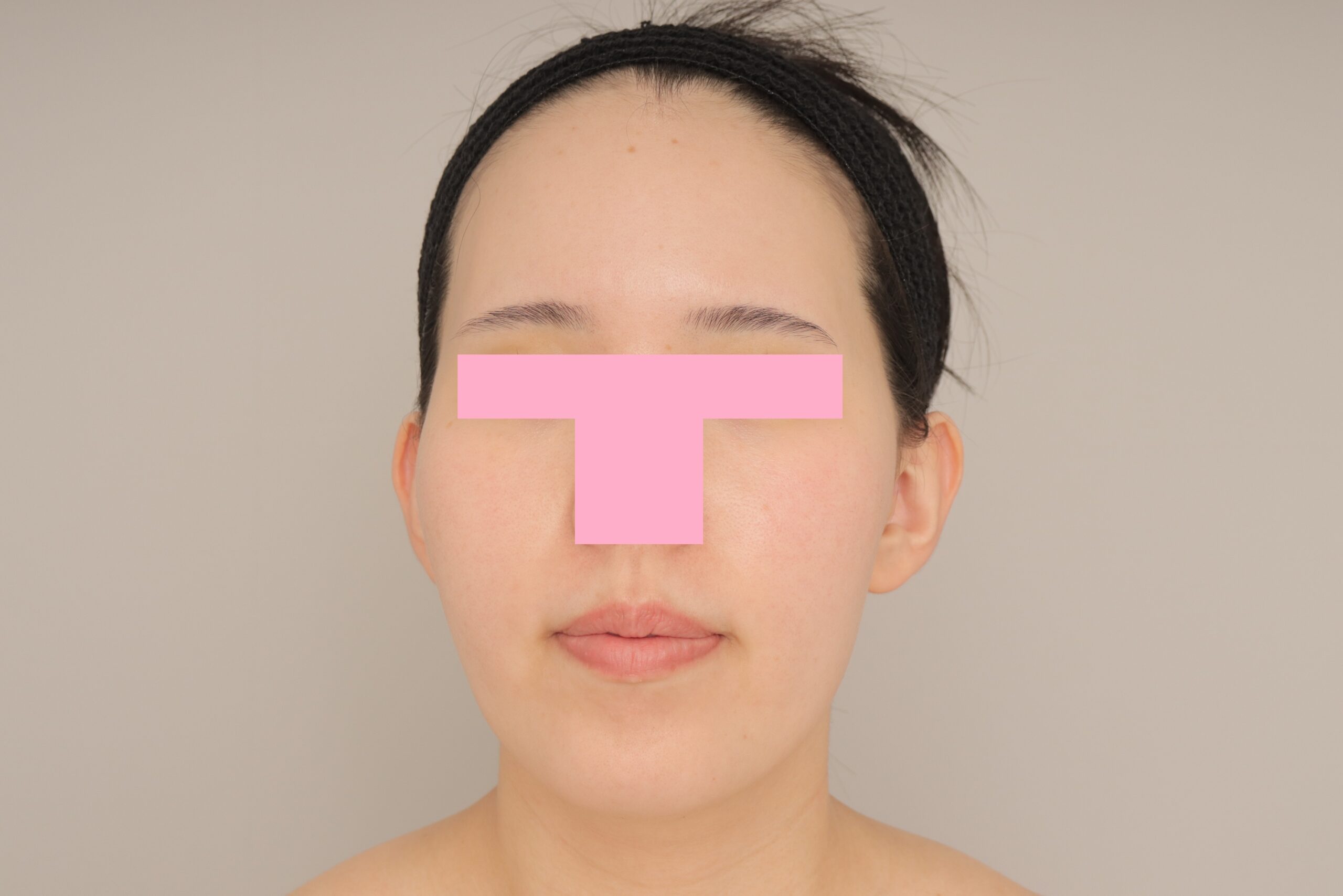 ベイザー脂肪吸引（6ヵ月経過：29）の術前写真