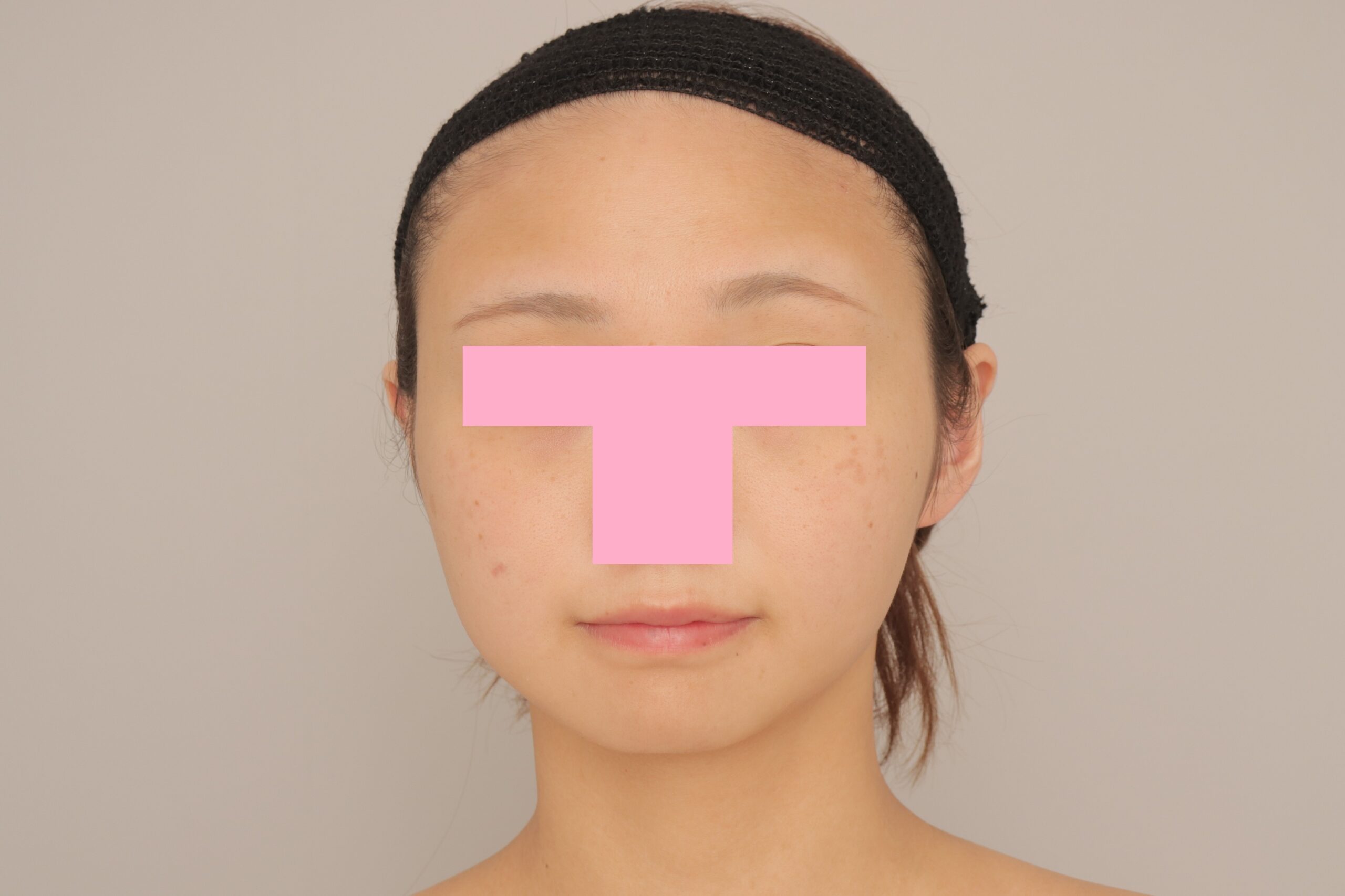 ベイザー脂肪吸引（6か月経過：24）の術後写真