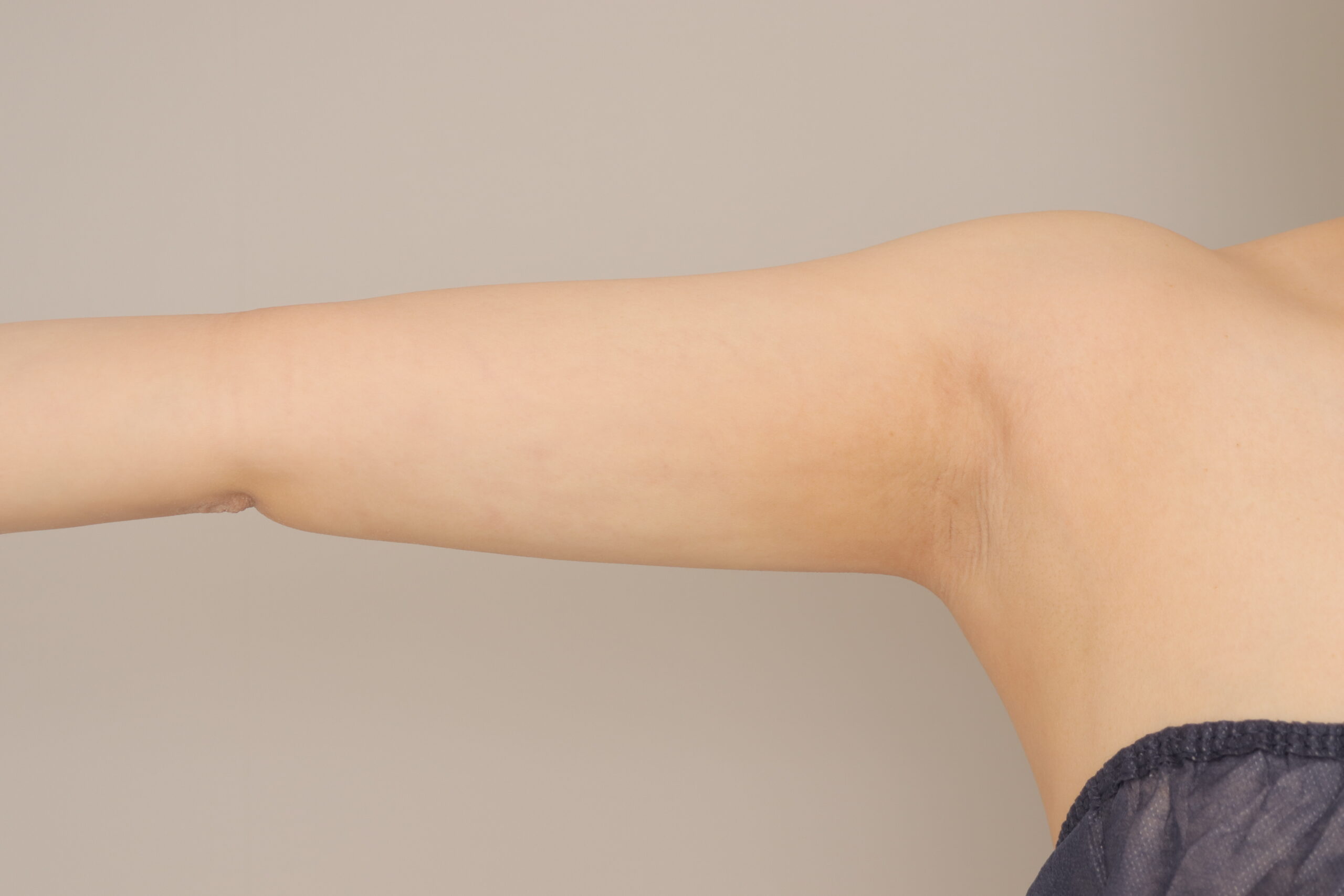 ベイザー脂肪吸引（１ヶ月経過：27）の術後写真