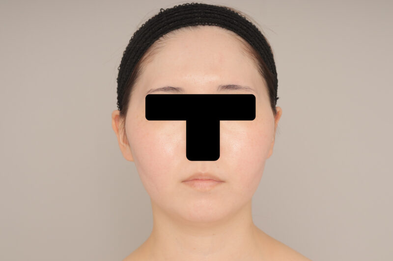 ベイザー脂肪吸引（６か月経過：27）の術前写真