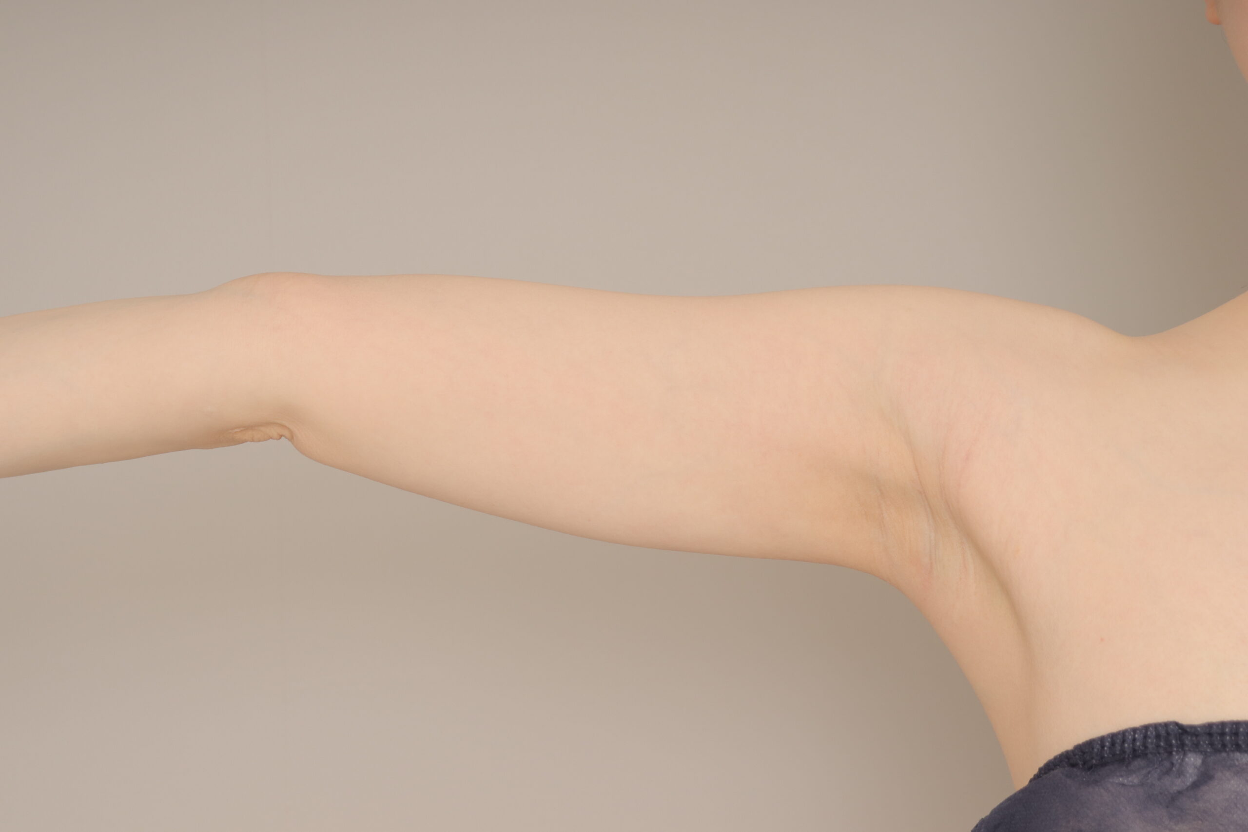 ベイザー脂肪吸引（6か月経過：29）の術後写真