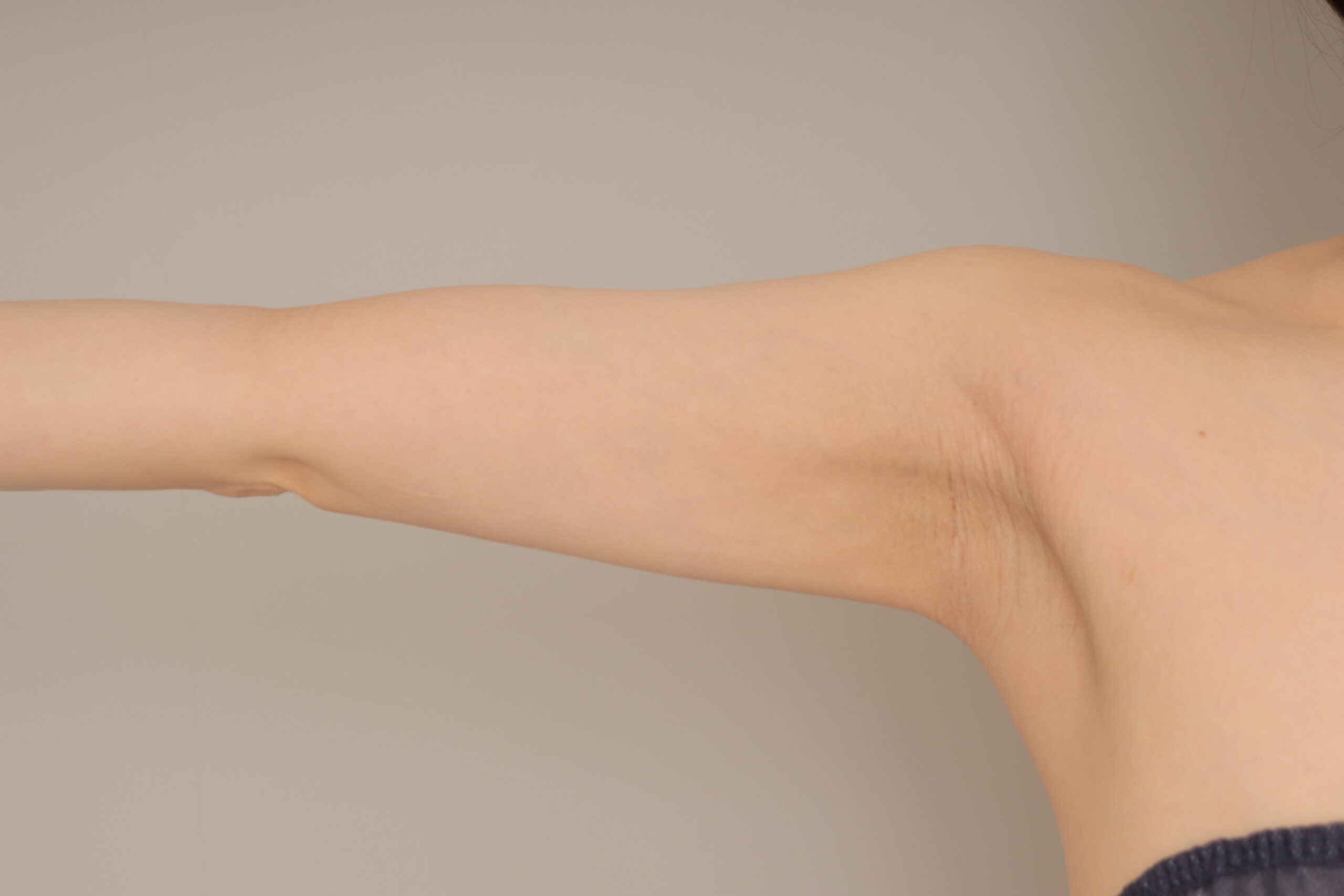 ベイザー脂肪吸引（6か月経過：36）の術後写真