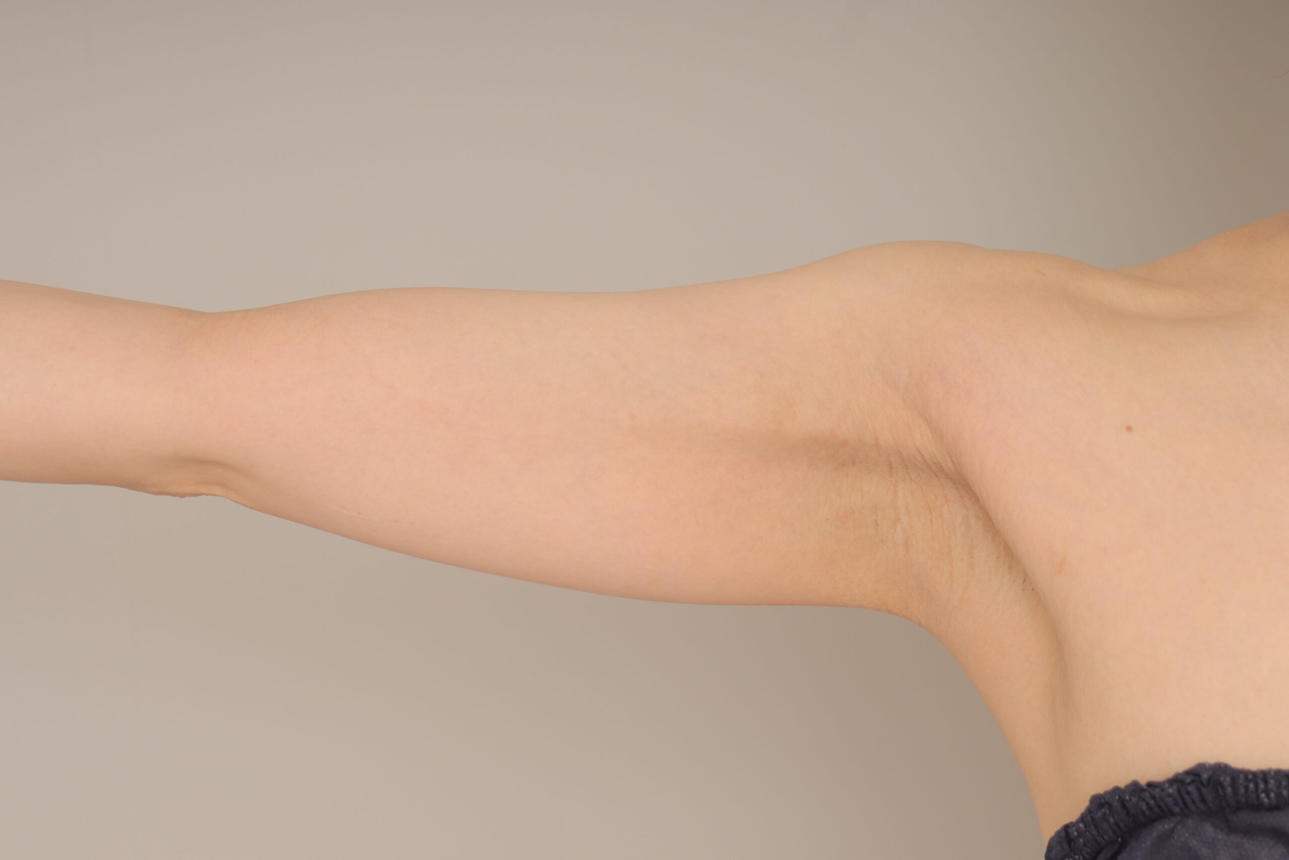 ベイザー脂肪吸引（6か月経過：36）の術前写真