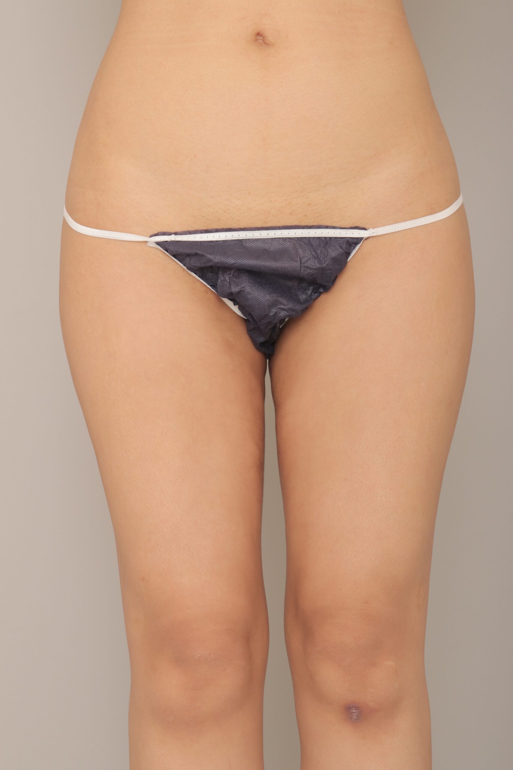 ベイザー脂肪吸引（3か月経過：28）の術後写真