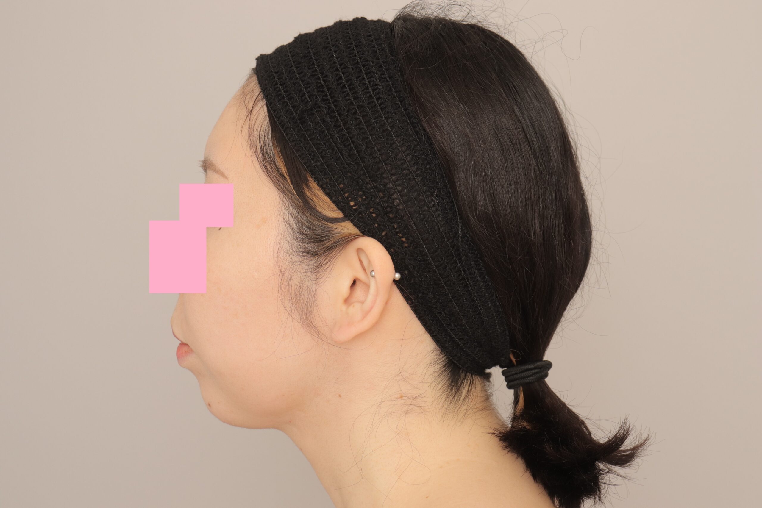 ベイザー脂肪吸引(6か月経過:33)の術後写真