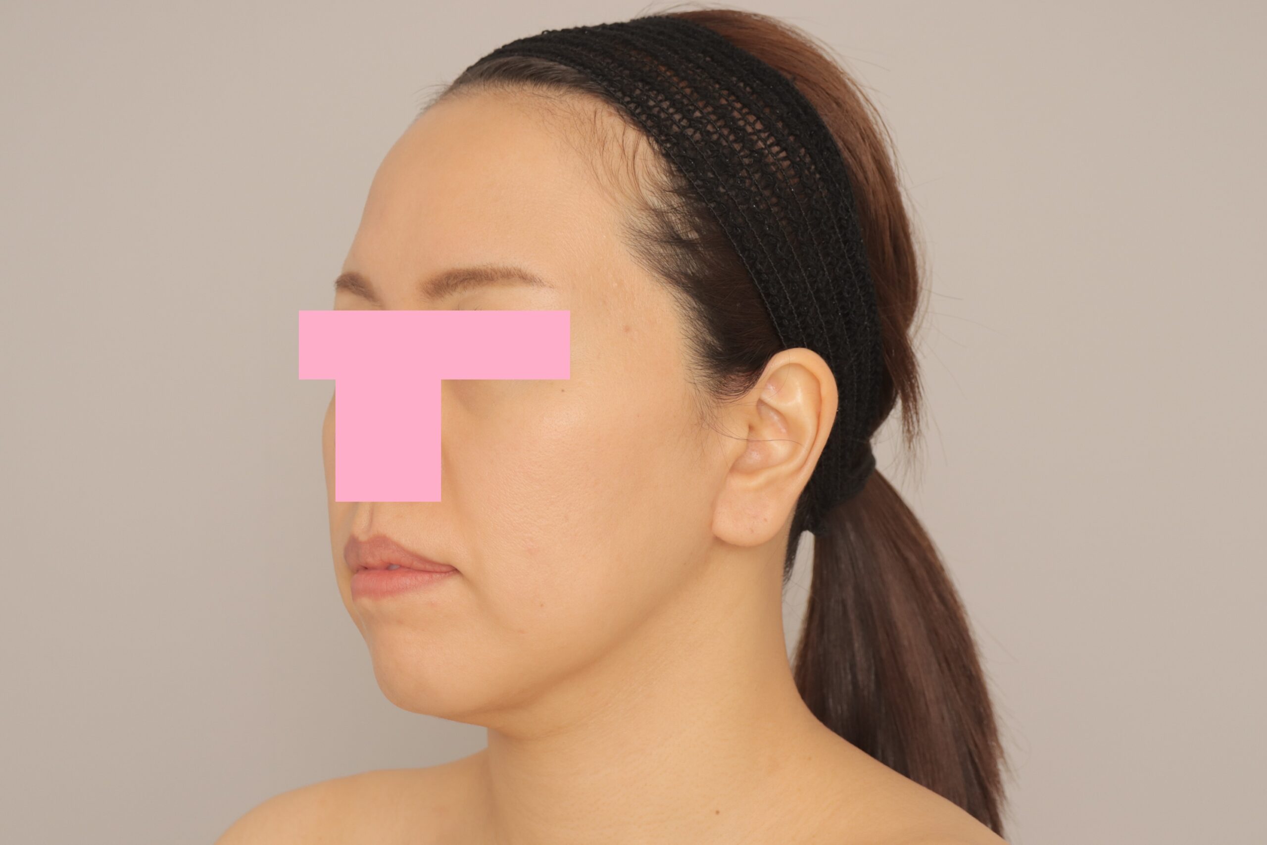 ベイザー脂肪吸引（6か月経過：37）の術後写真