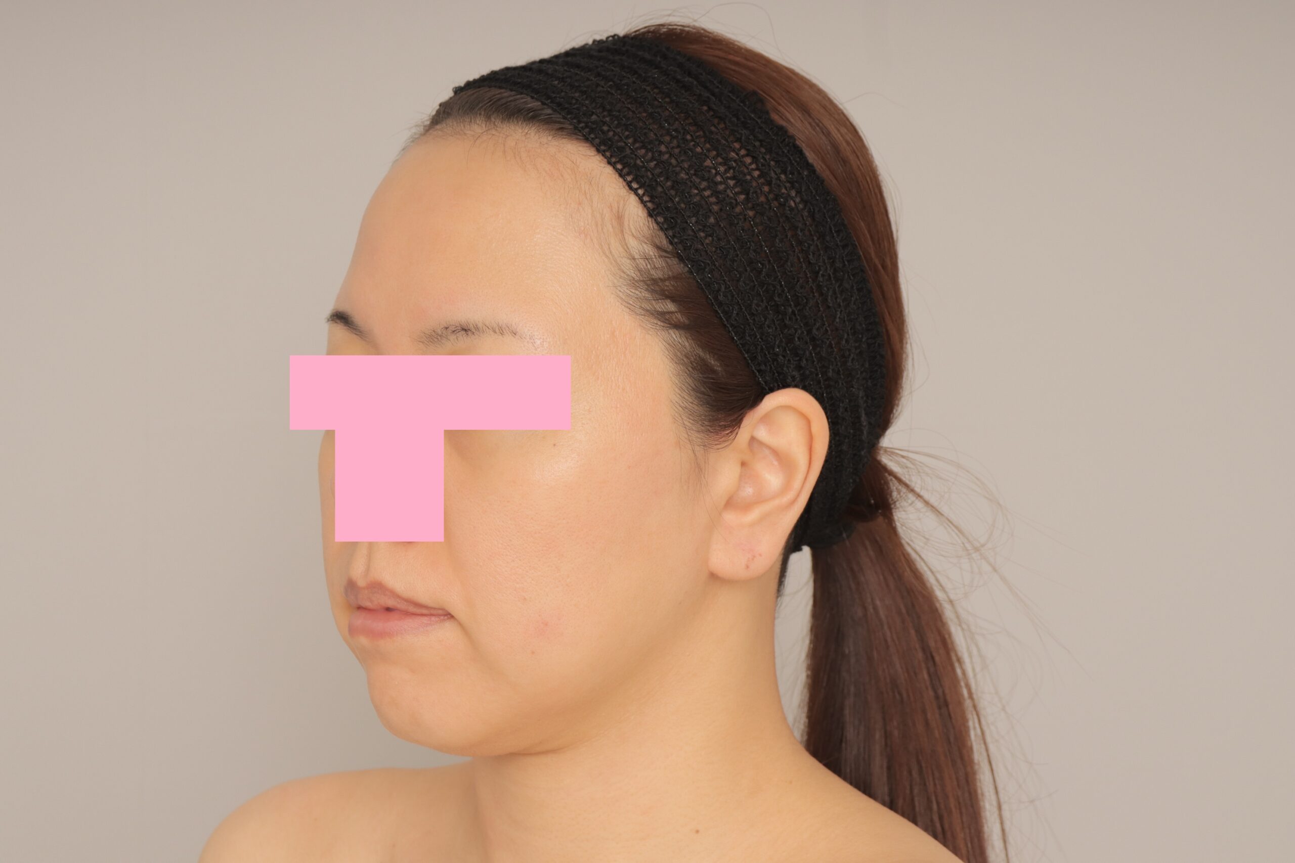 ベイザー脂肪吸引（6か月経過：37）の術前写真