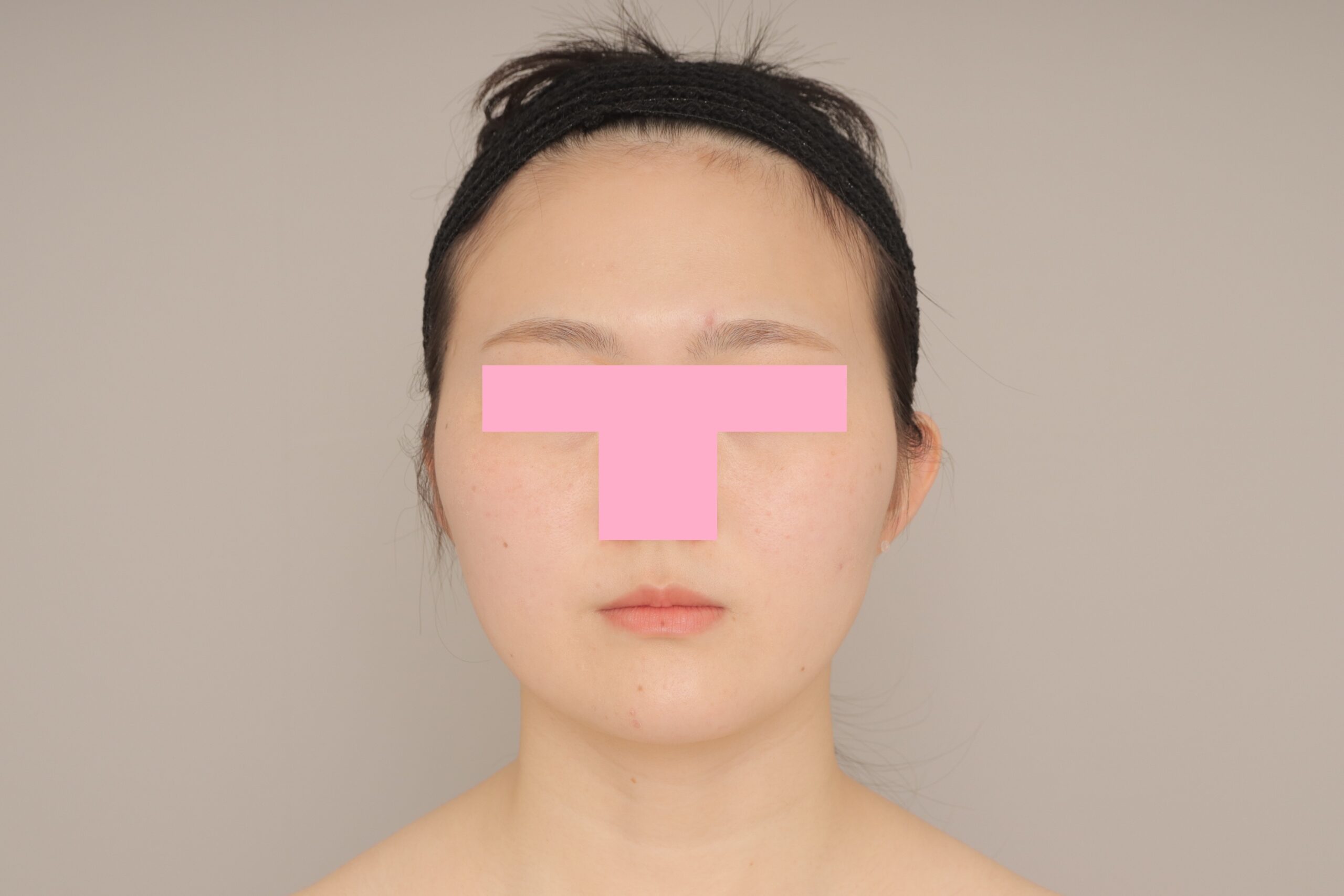 ベイザー脂肪吸引（6か月経過：25）の術後写真