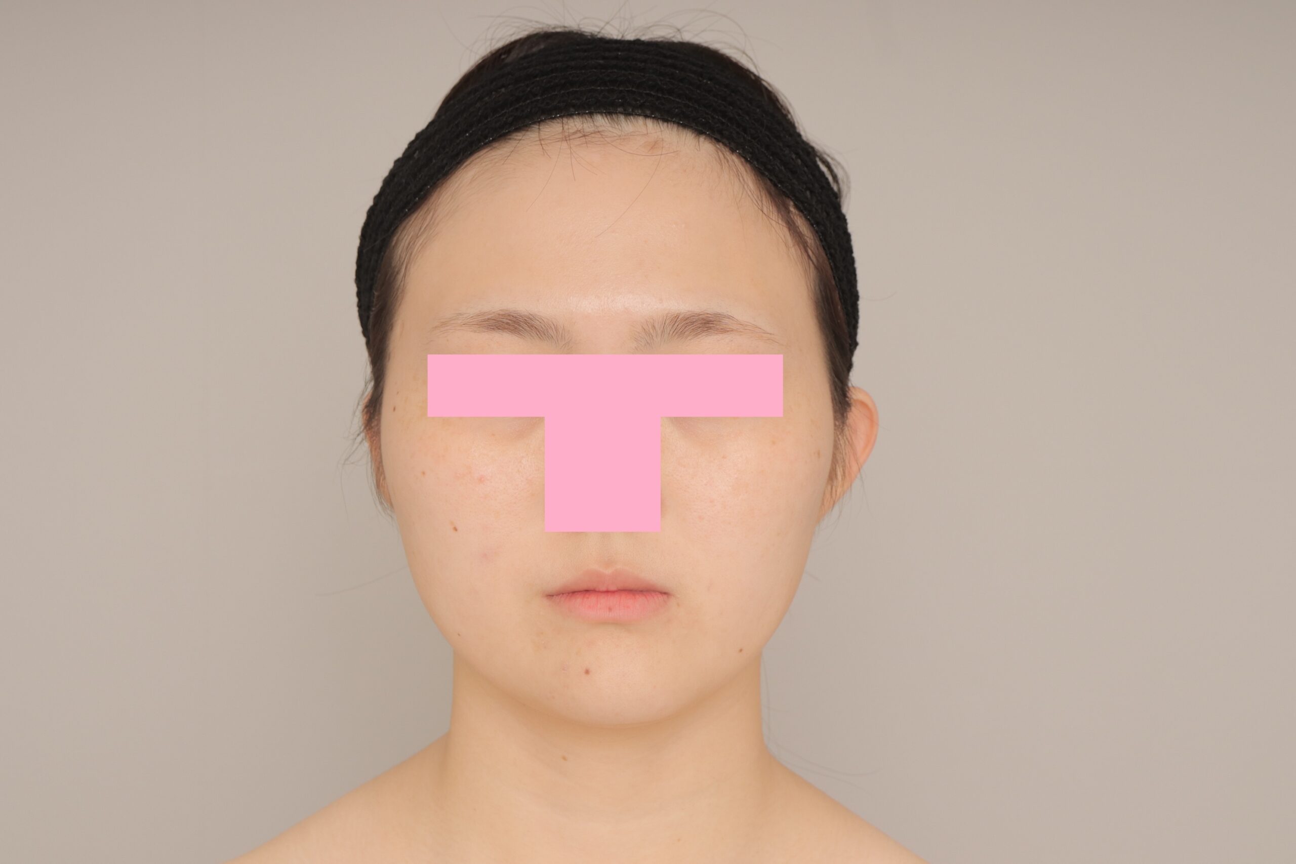 ベイザー脂肪吸引（6か月経過：25）の術前写真