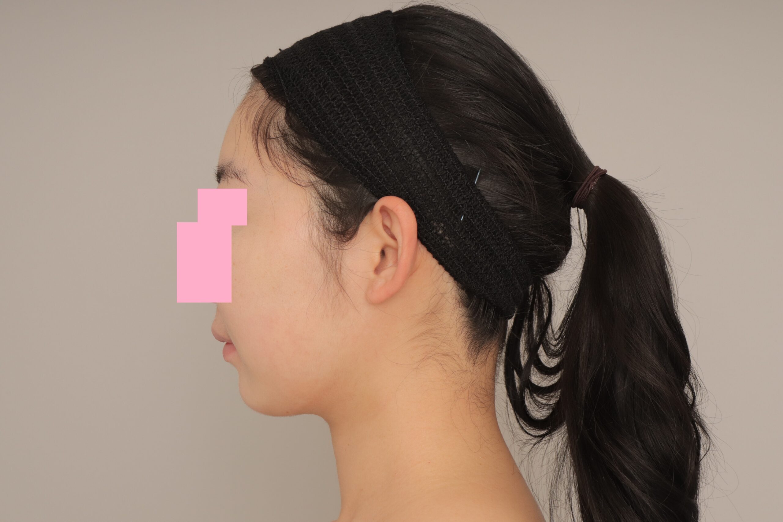 ベイザー脂肪吸引（6ヵ月経過：26）の術後写真