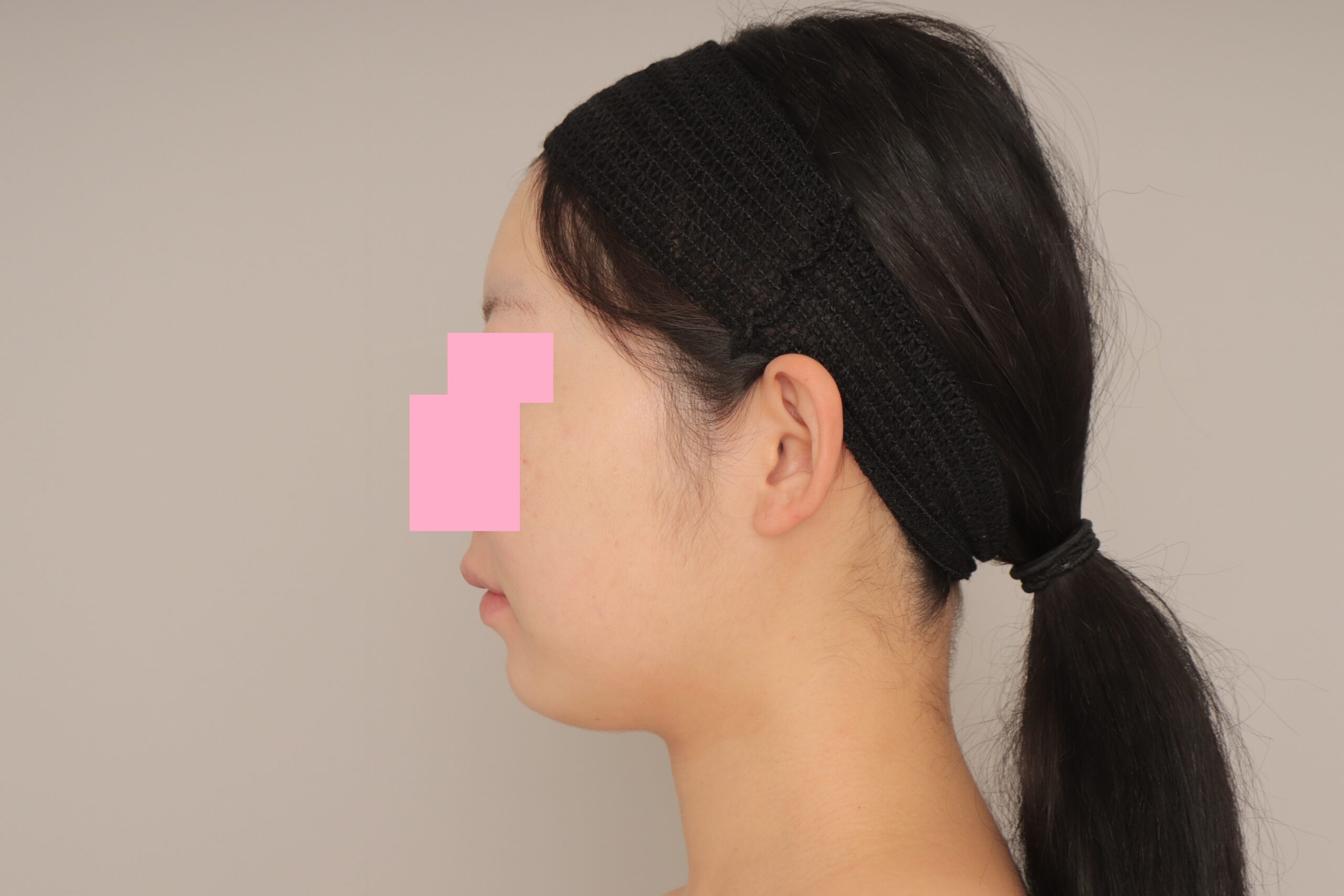 ベイザー脂肪吸引（6ヵ月経過：26）の術前写真