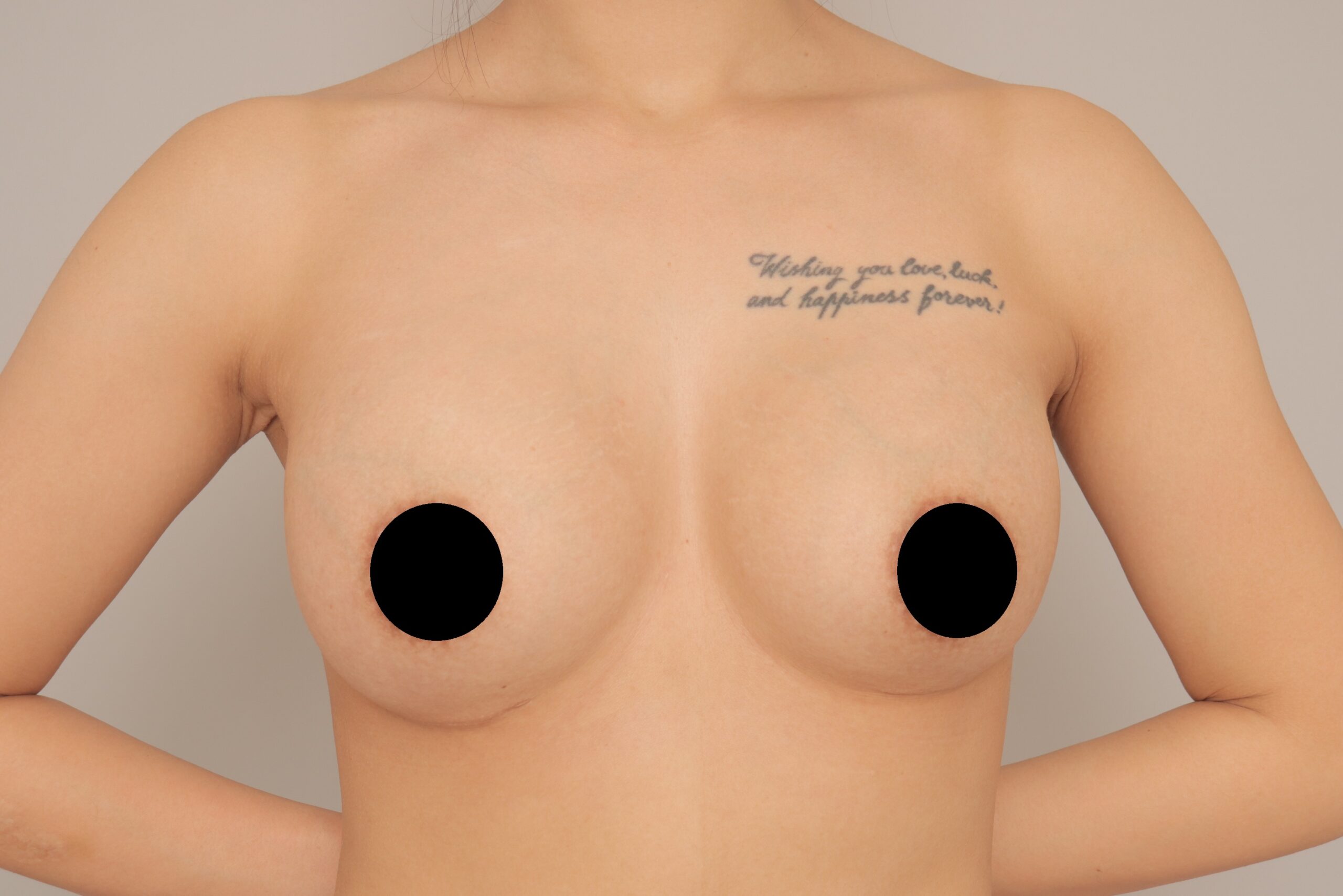 ベイザー脂肪吸引(3か月経過:27)の術後写真