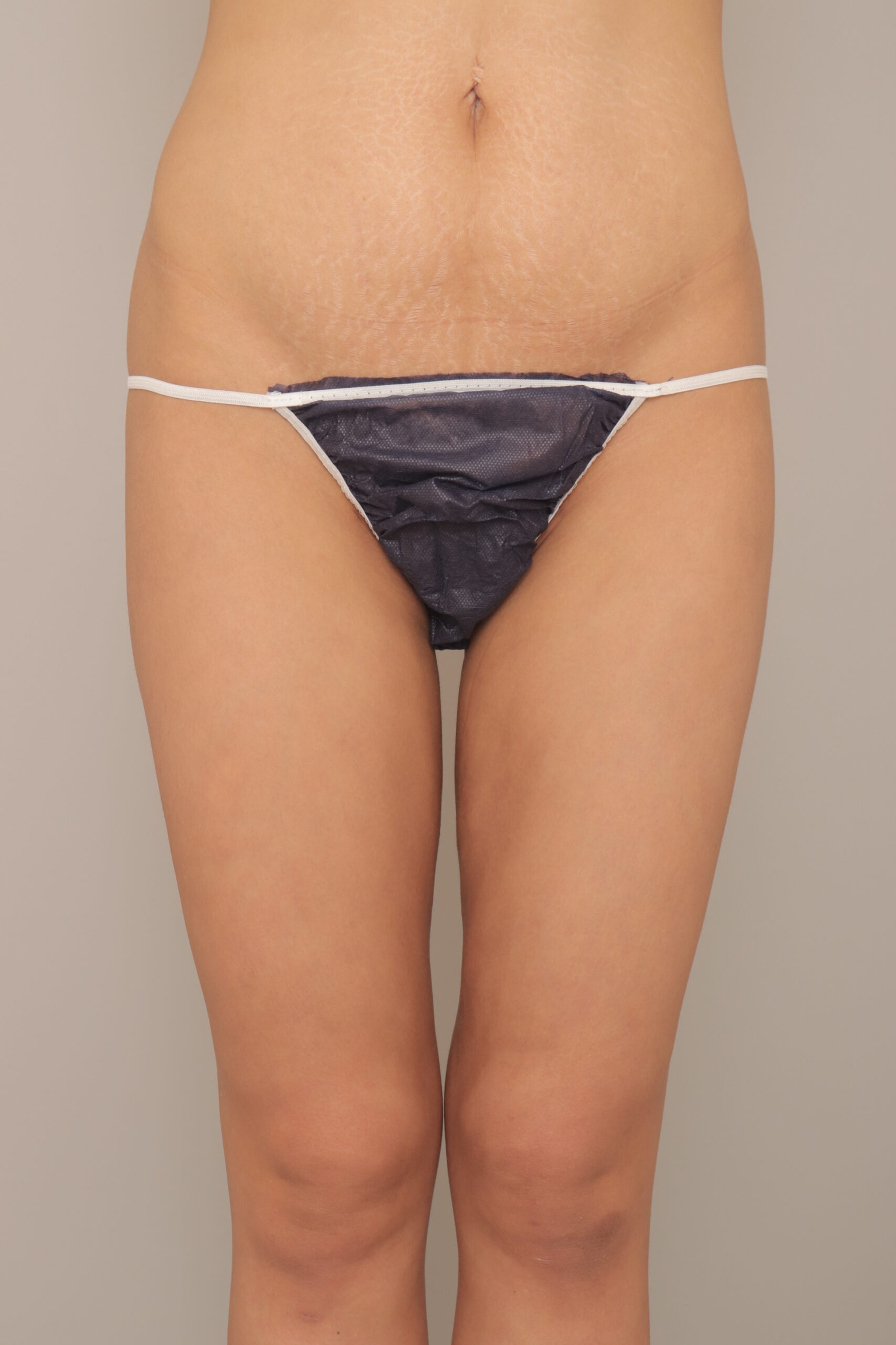 ベイザー脂肪吸引(3か月経過:27)の術後写真