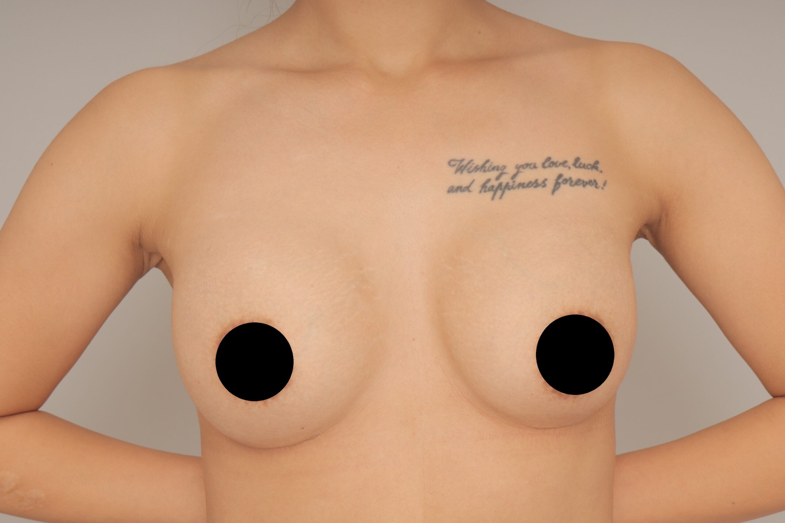 ベイザー脂肪吸引(3か月経過:27)の術前写真