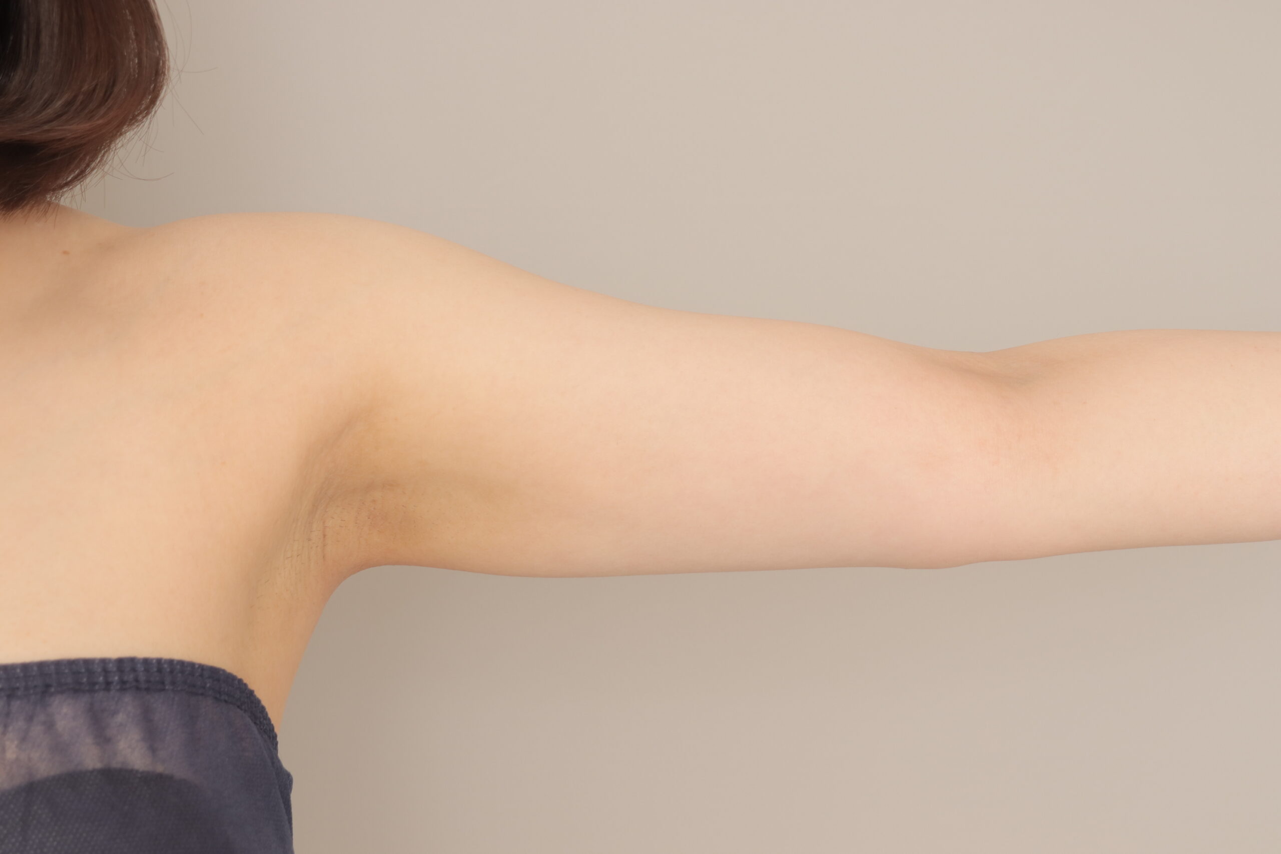 ベイザー脂肪吸引（3か月経過：28）の術後写真