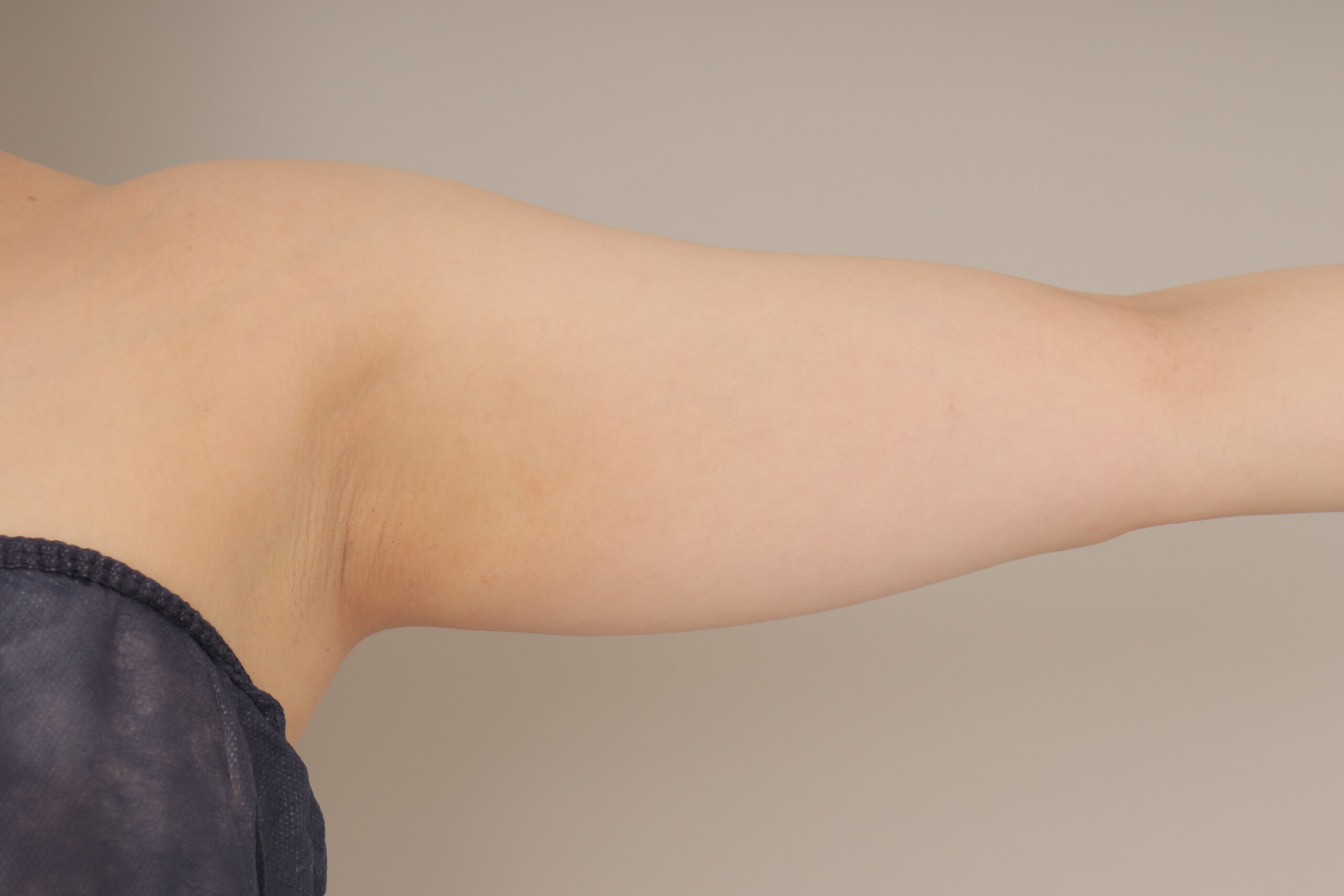 ベイザー脂肪吸引（3か月経過：28）の術前写真