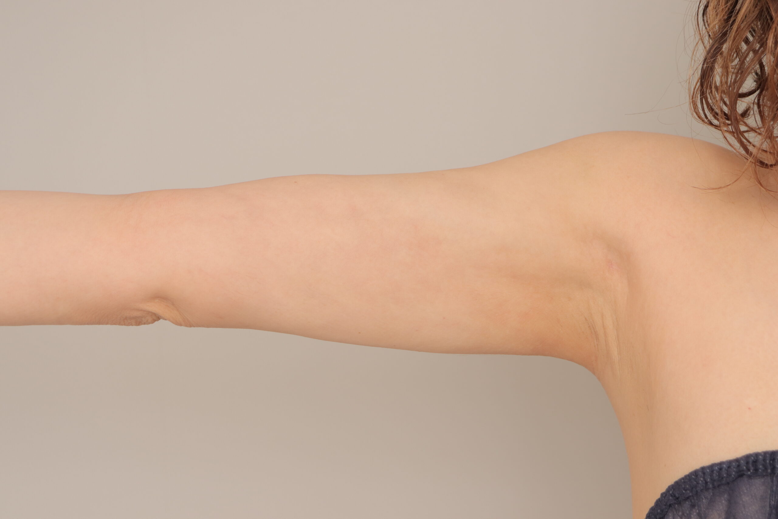 ベイザー脂肪吸引（3か月経過：45）の術後写真