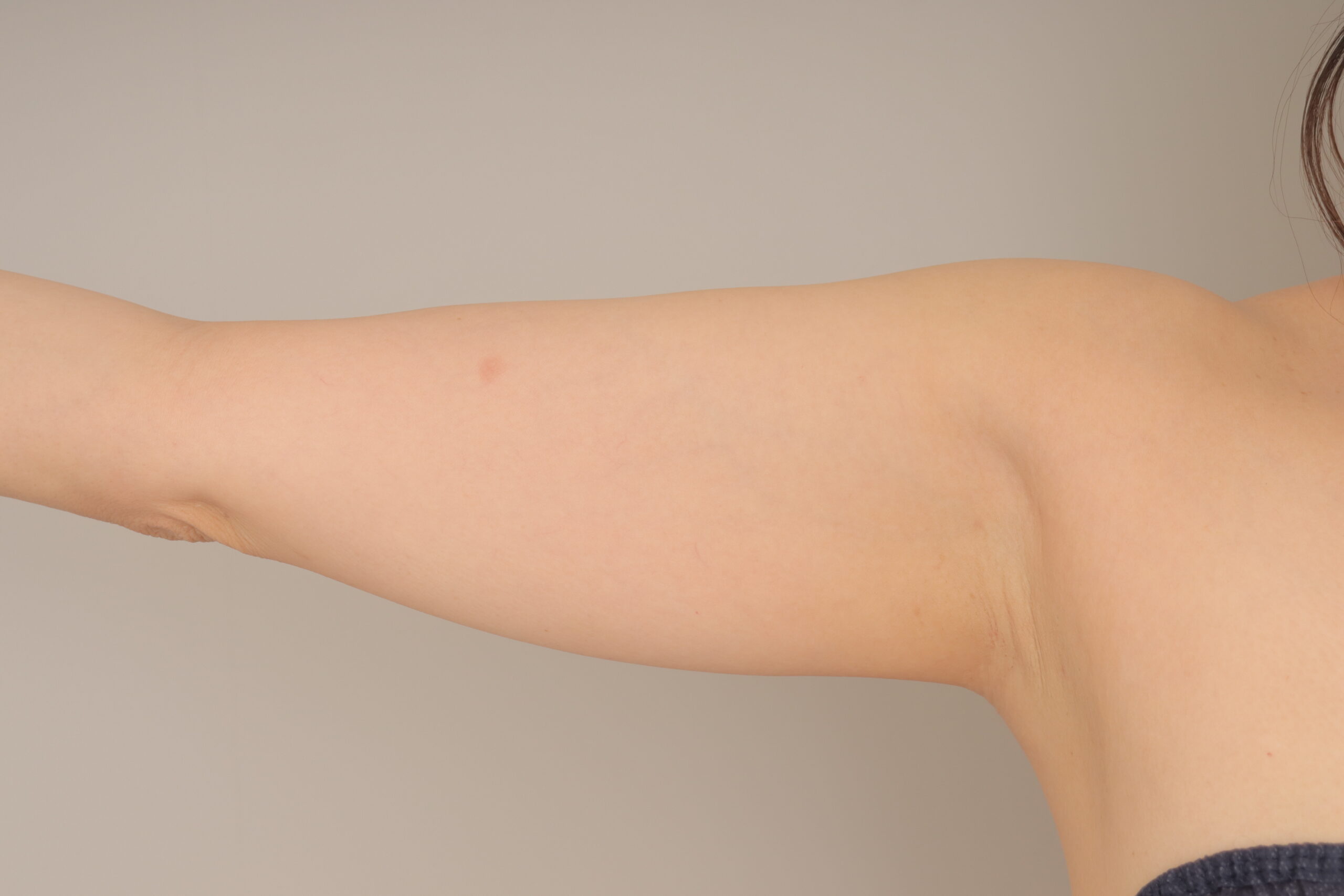 ベイザー脂肪吸引（3か月経過：45）の術前写真