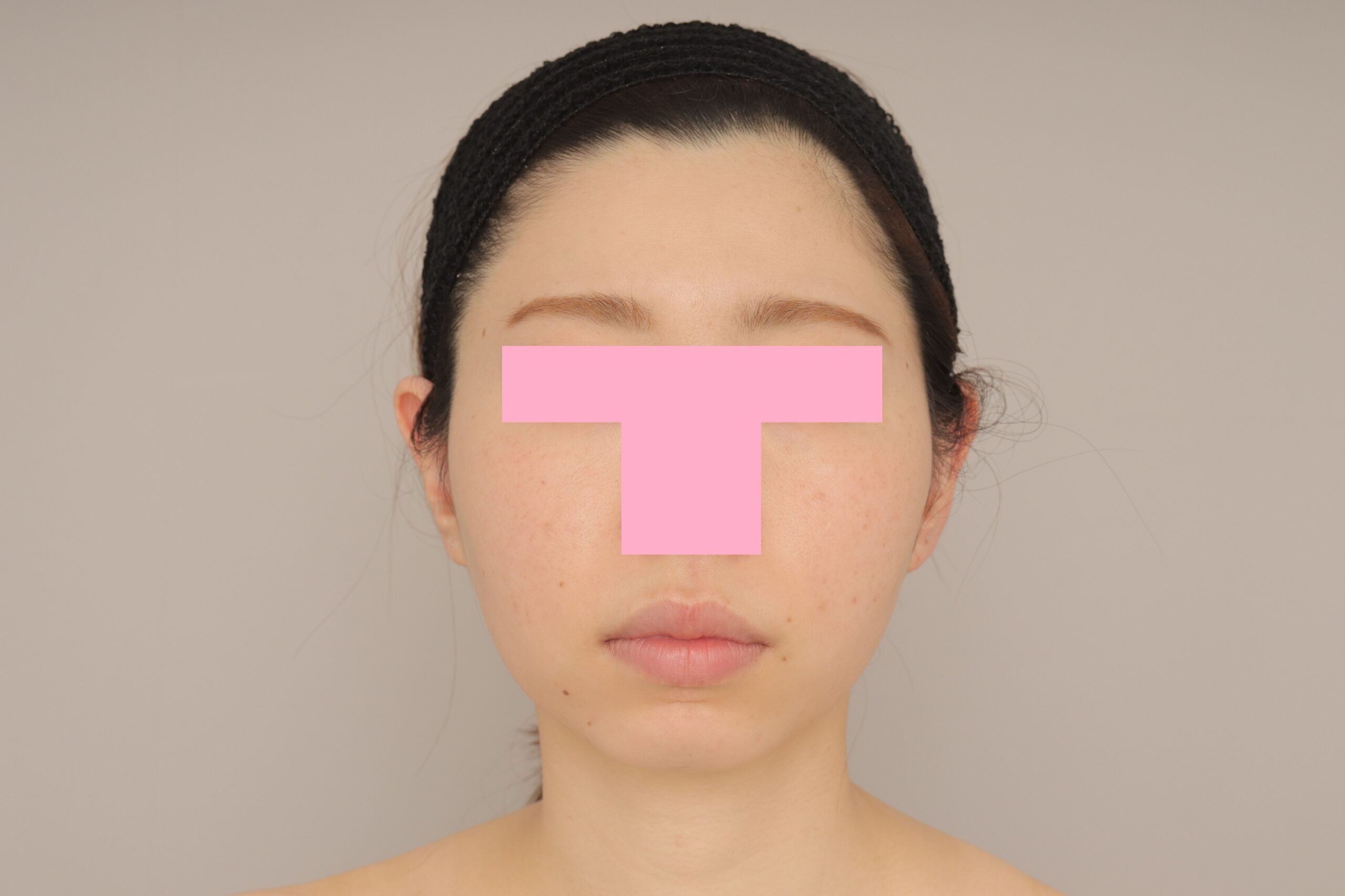 ベイザー脂肪吸引(3か月経過:28)の術後写真