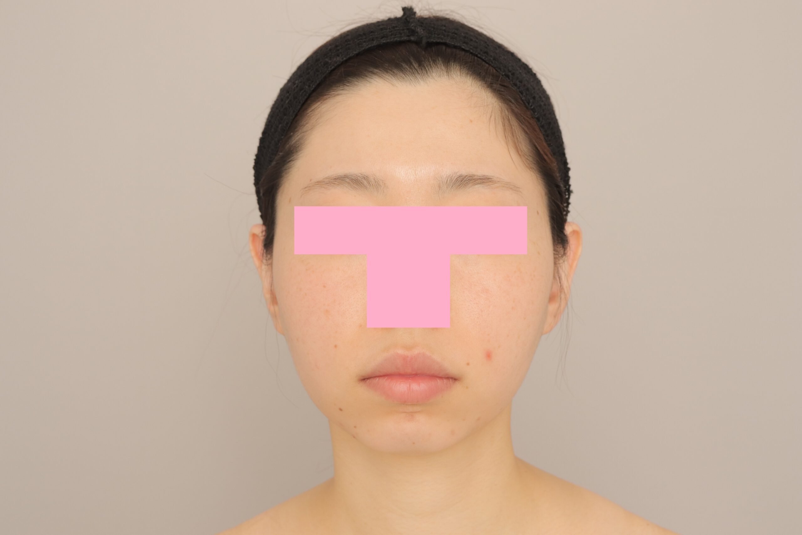 ベイザー脂肪吸引(3か月経過:28)の術前写真