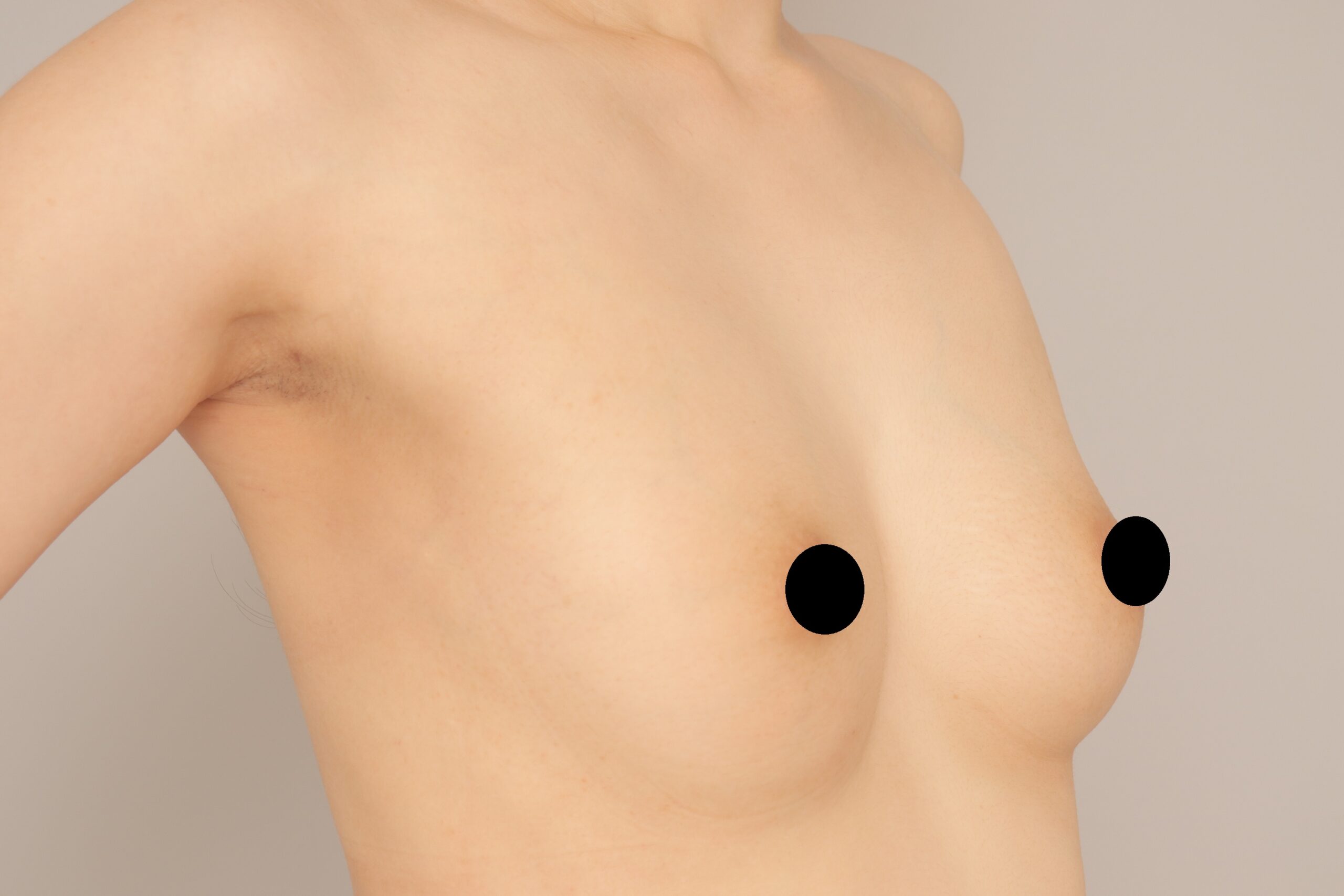 ベイザー脂肪吸引(3か月経過:31)の術後写真