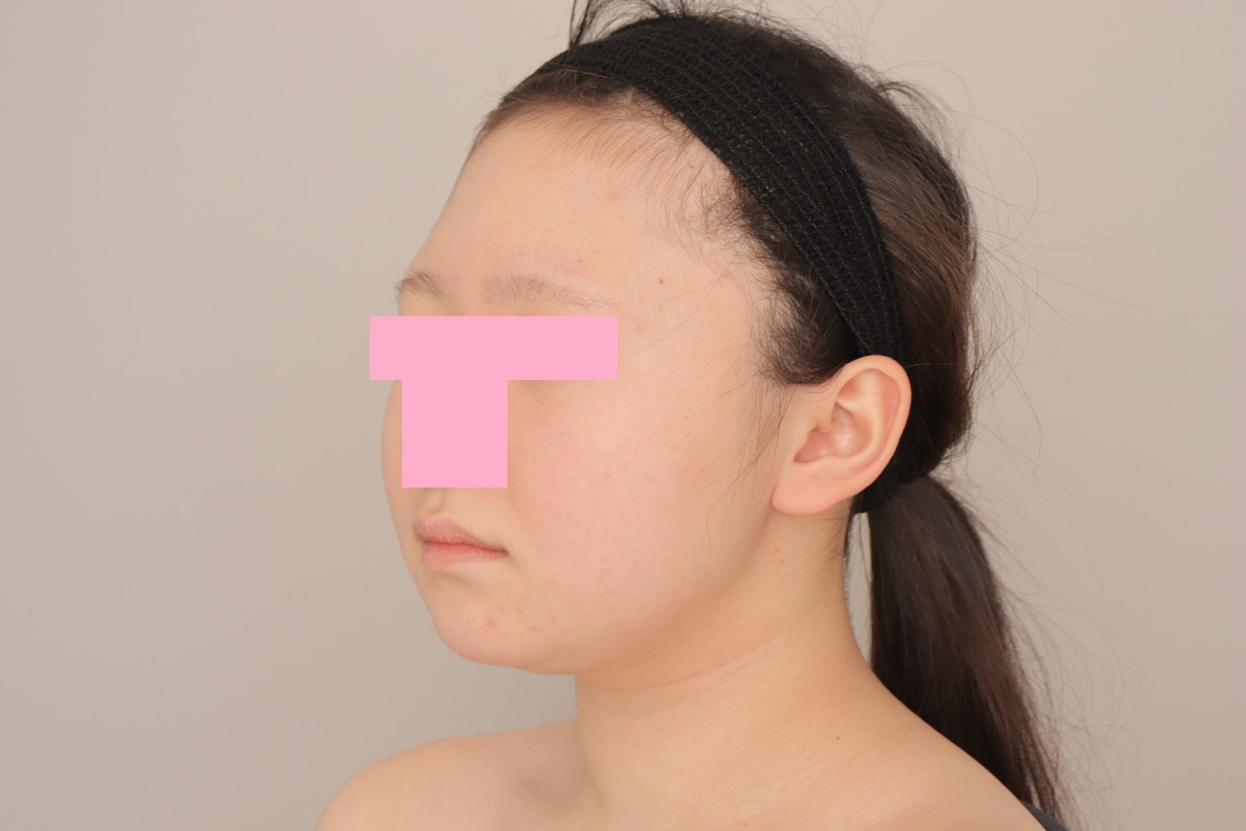 ベイザー脂肪吸引(3か月経過:18)の術前写真