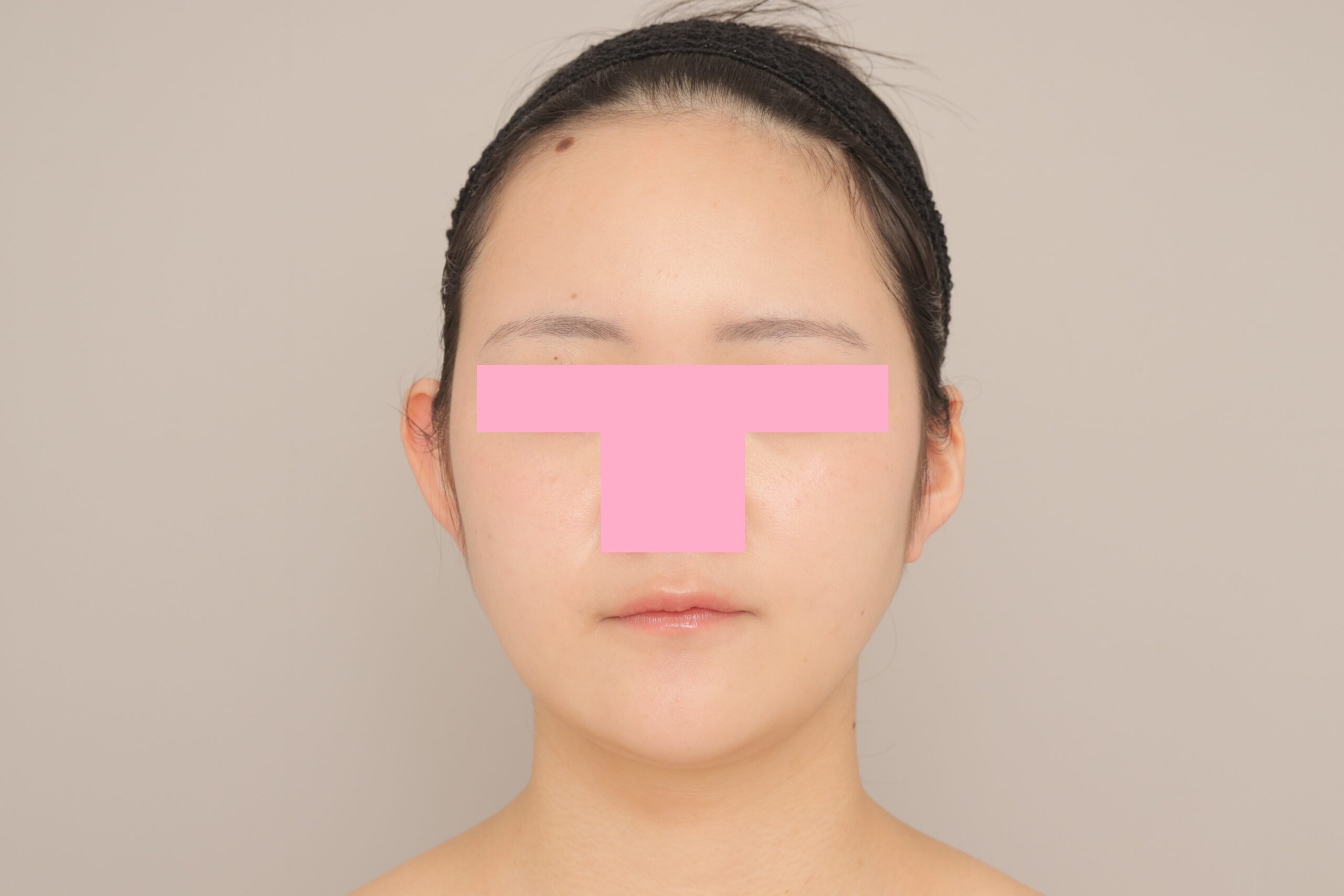 ベイザー脂肪吸引（3か月経過：22）の術後写真