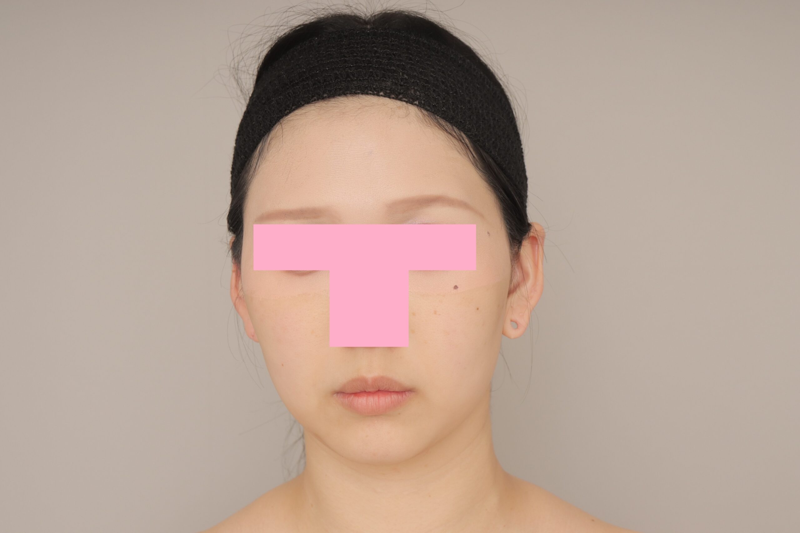 ベイザー脂肪吸引（3か月経過：31）の術後写真