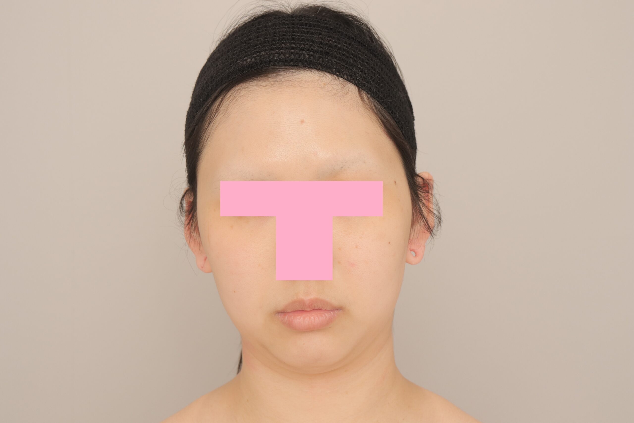 ベイザー脂肪吸引（3か月経過：31）の術前写真