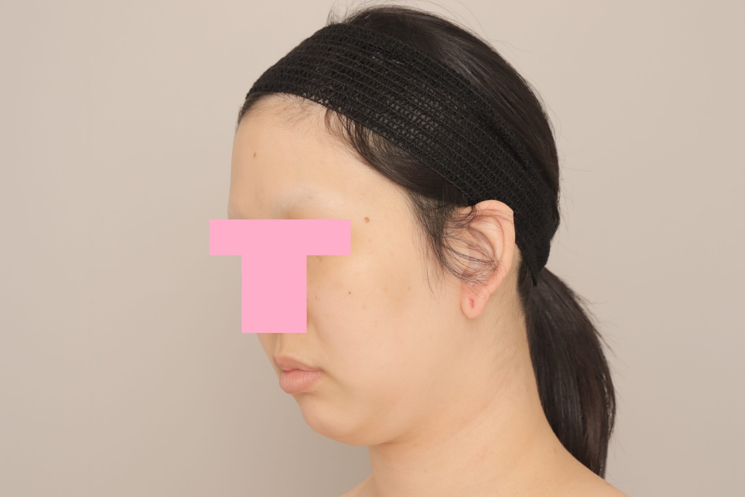 ベイザー脂肪吸引(6か月経過:31)の術前写真