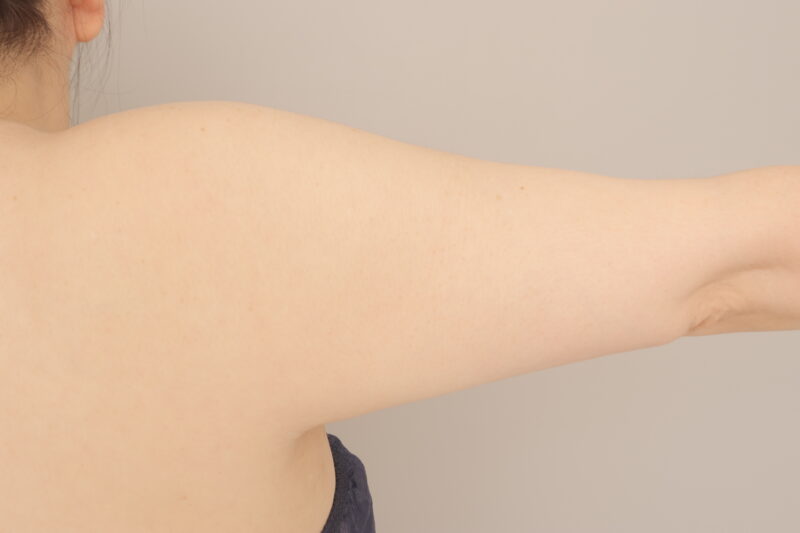 ベイザー脂肪吸引(2ヶ月経過:51)の術前写真