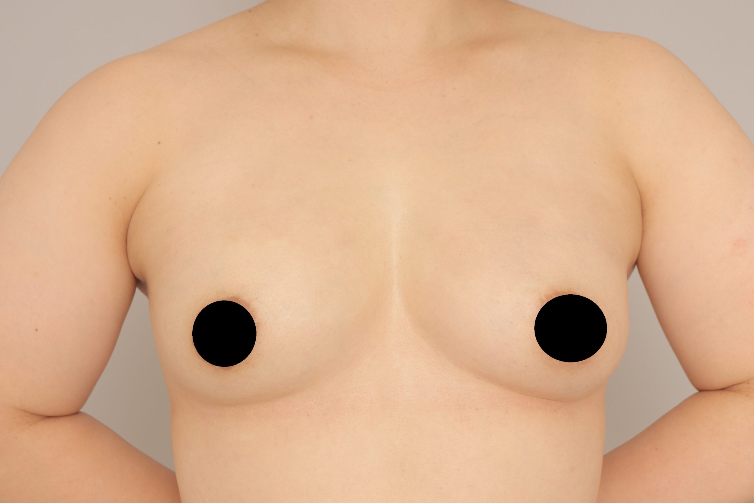 ベイザー脂肪吸引（1ヵ月経過：42）の術後写真