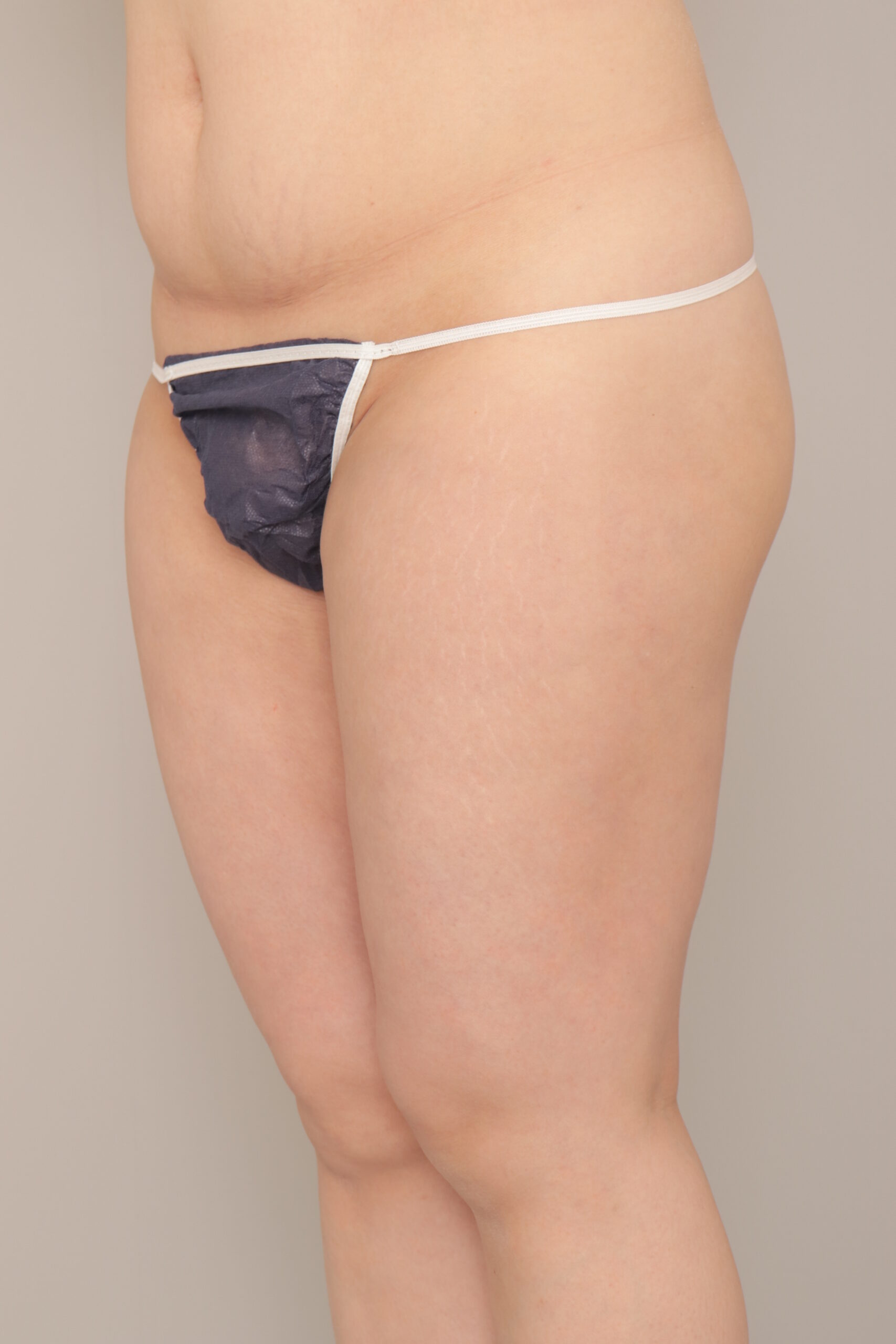 ベイザー脂肪吸引（1ヵ月経過：41）の術後写真