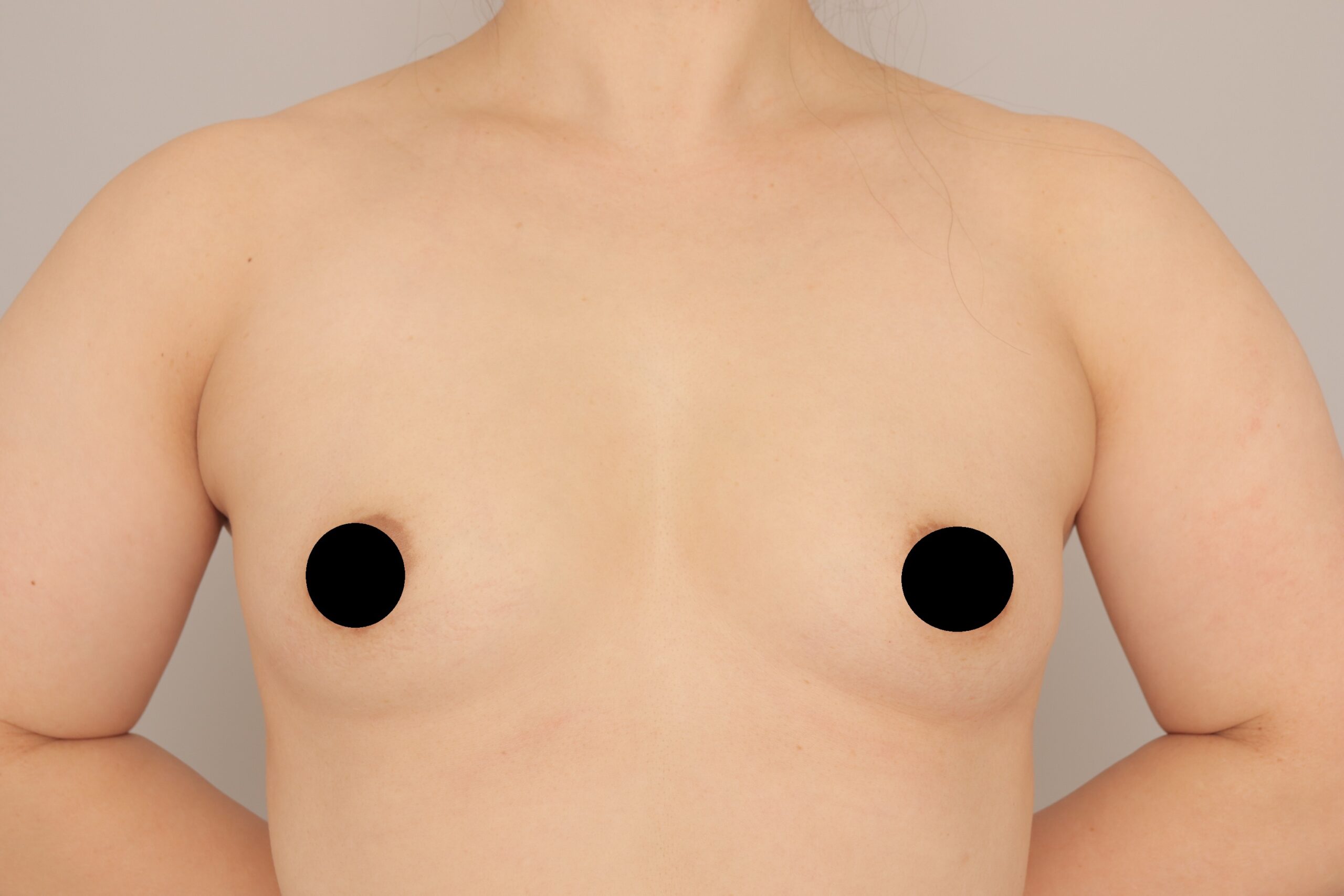 ベイザー脂肪吸引（1ヵ月経過：42）の術前写真