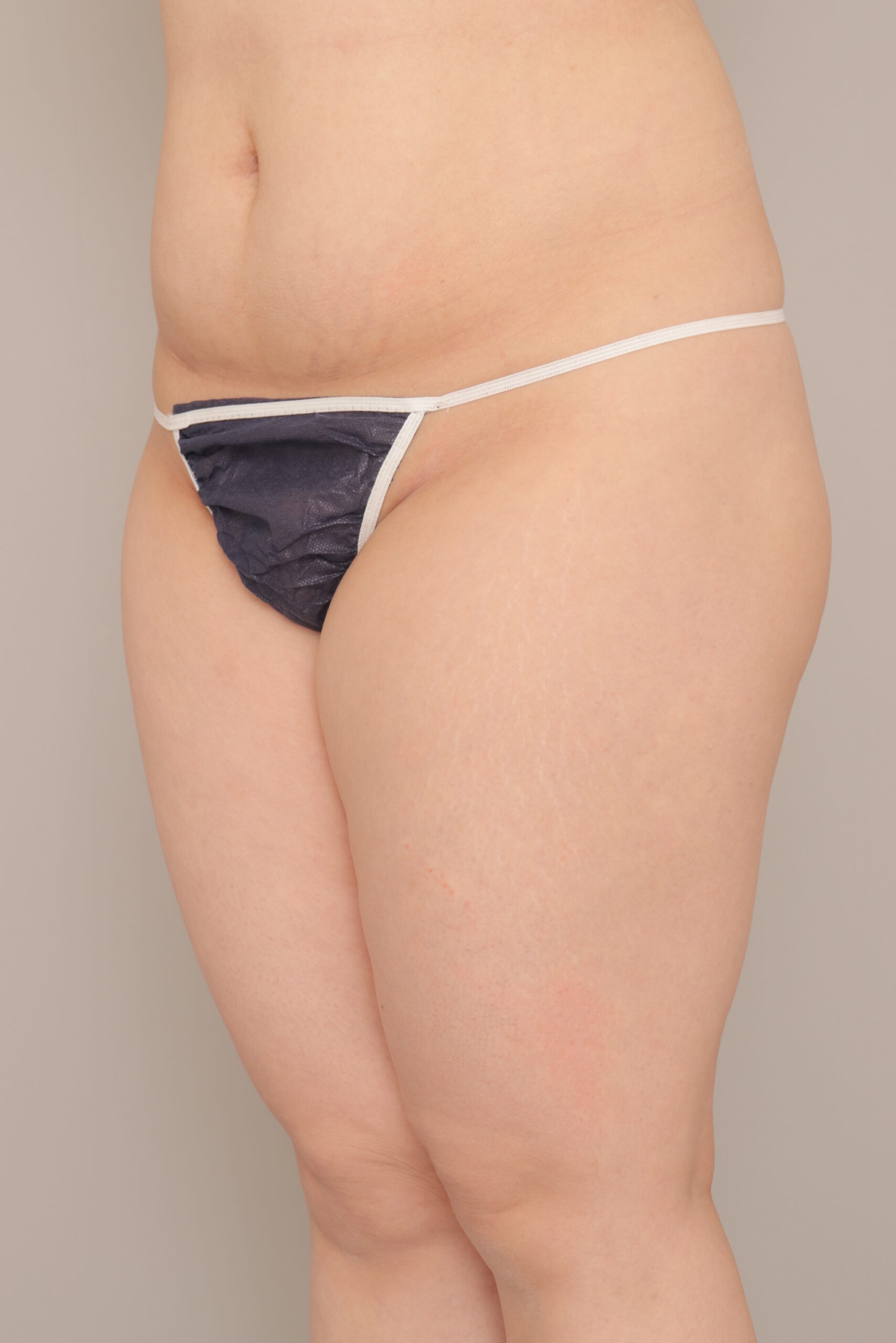 ベイザー脂肪吸引（1ヵ月経過：41）の術前写真