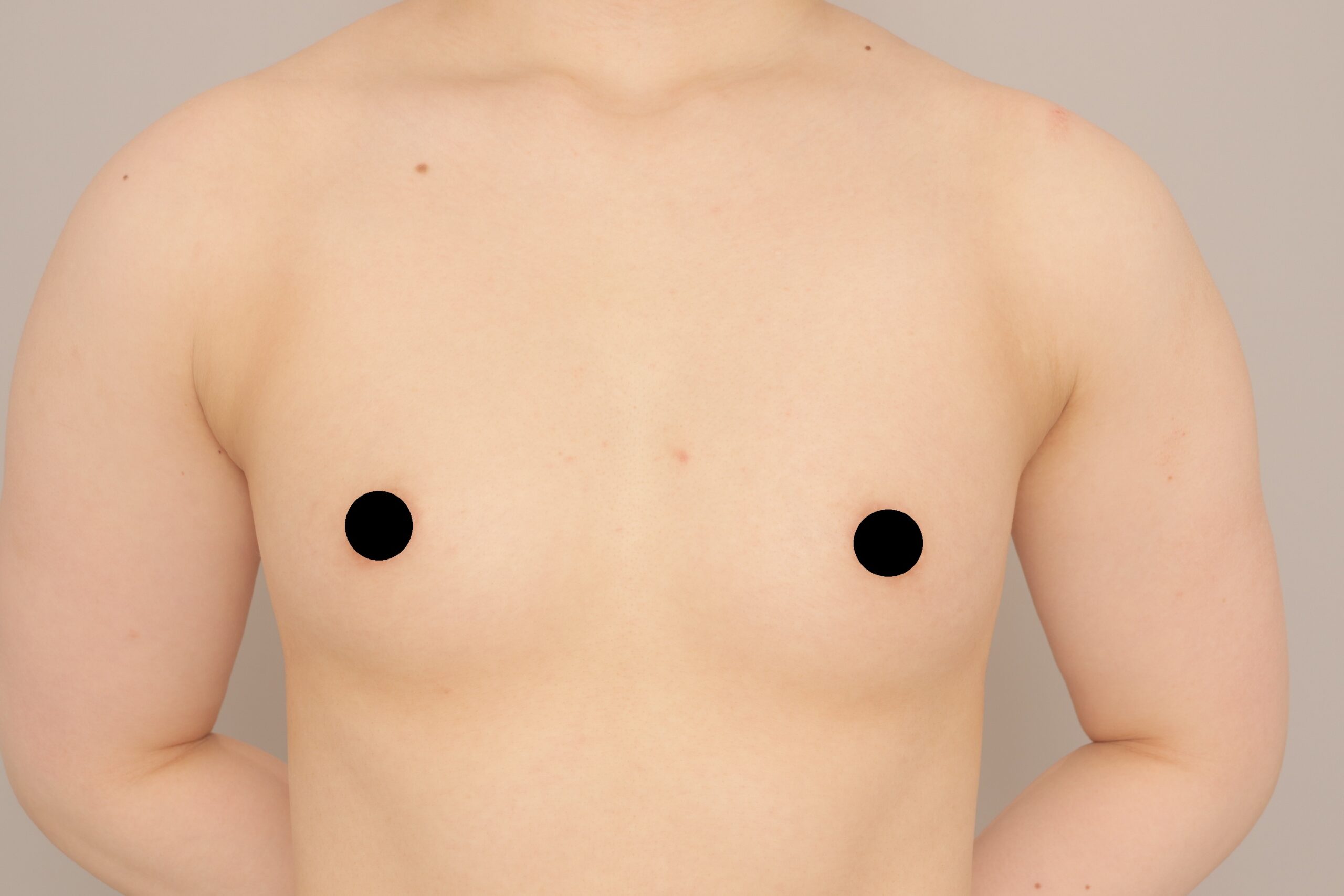 ベイザー脂肪吸引（1ヵ月経過：22）の術前写真