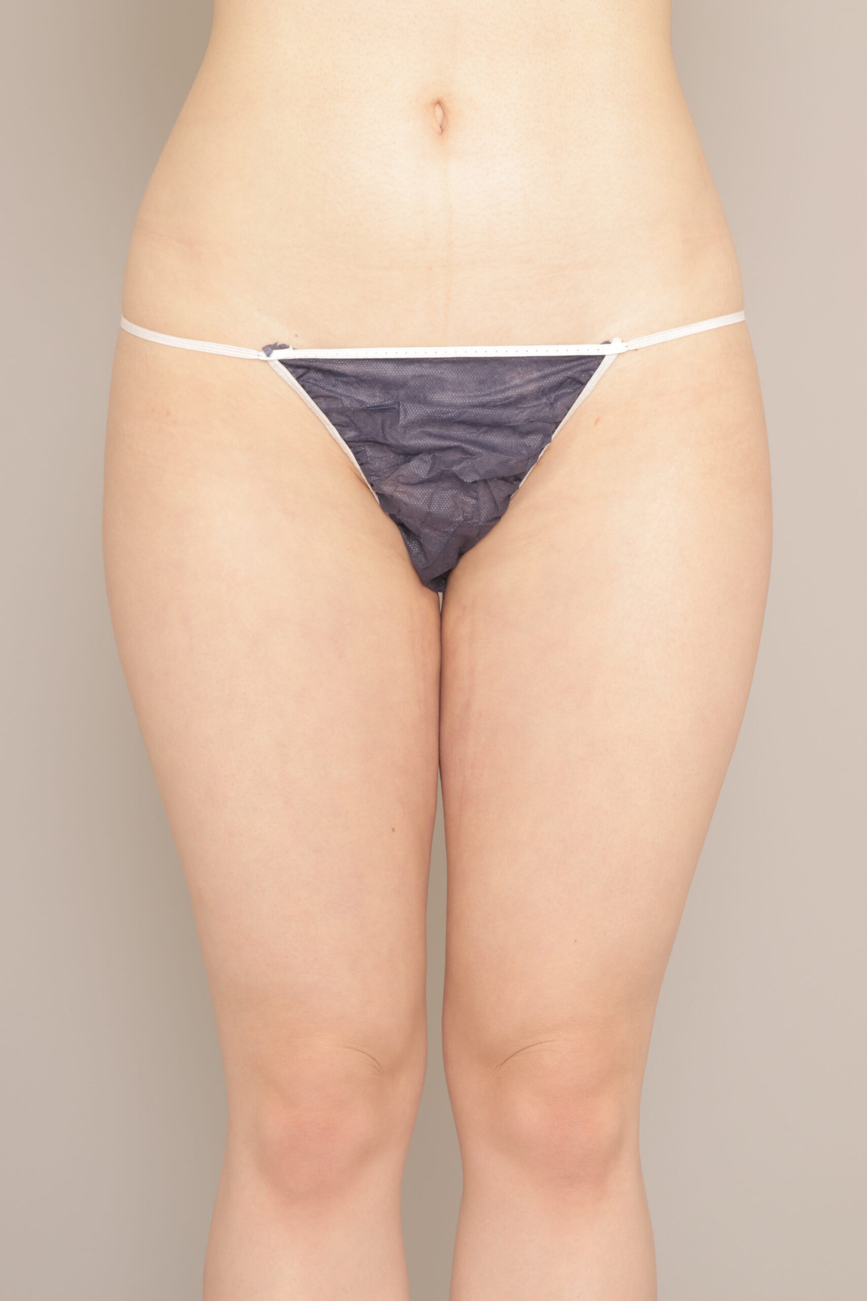 太腿脂肪吸引1ヵ月後!これぐらいの変化でも心配しないで!ここからまだ細くなります。 モニター様の1か月経過をご紹介 26歳 163cm 57kg