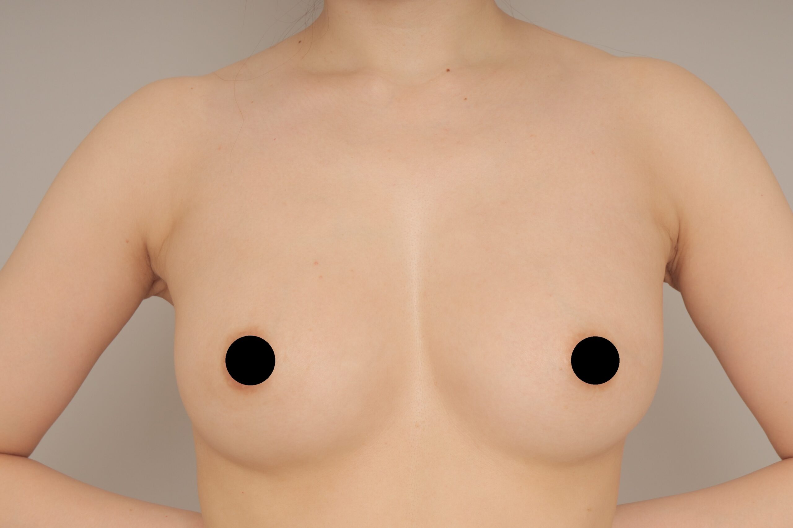 ベイザー脂肪吸引（1ヵ月経過：35）の術後写真