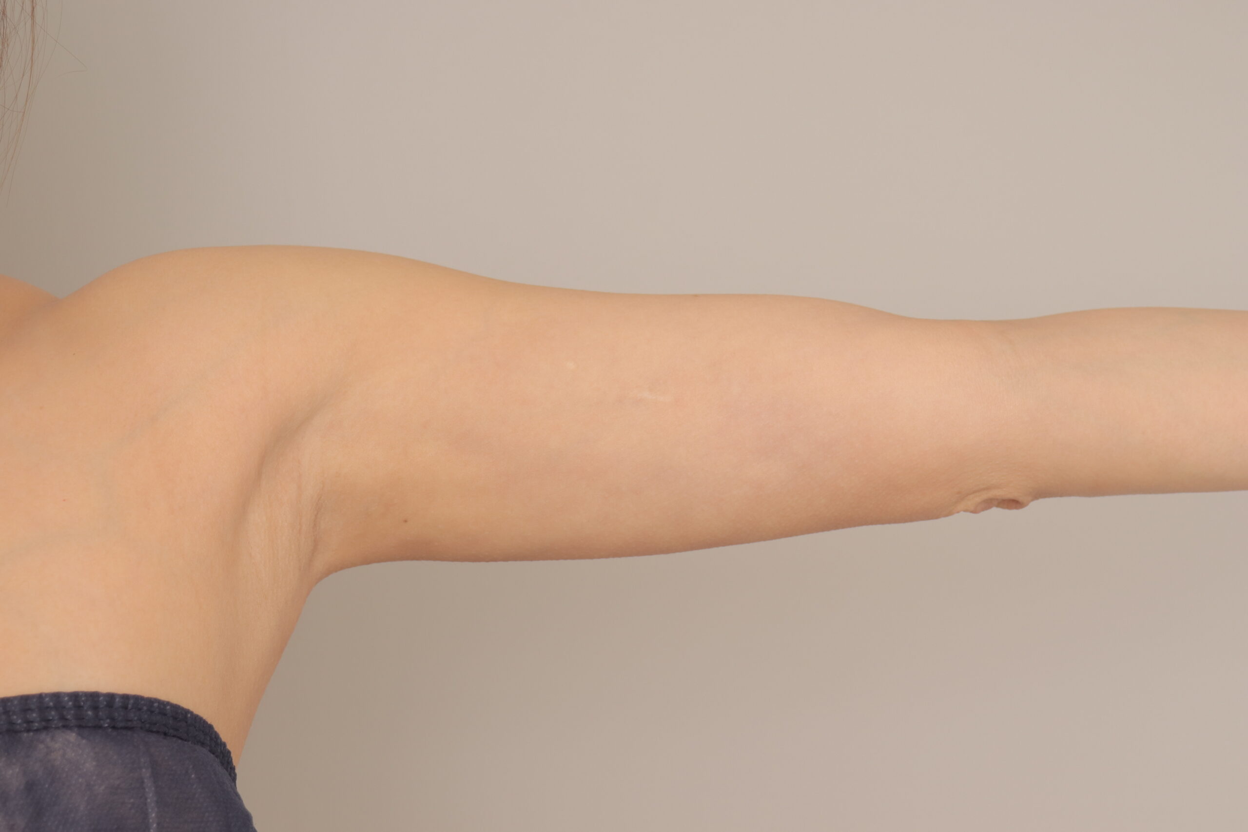 ベイザー脂肪吸引（1ヵ月経過：42）の術後写真