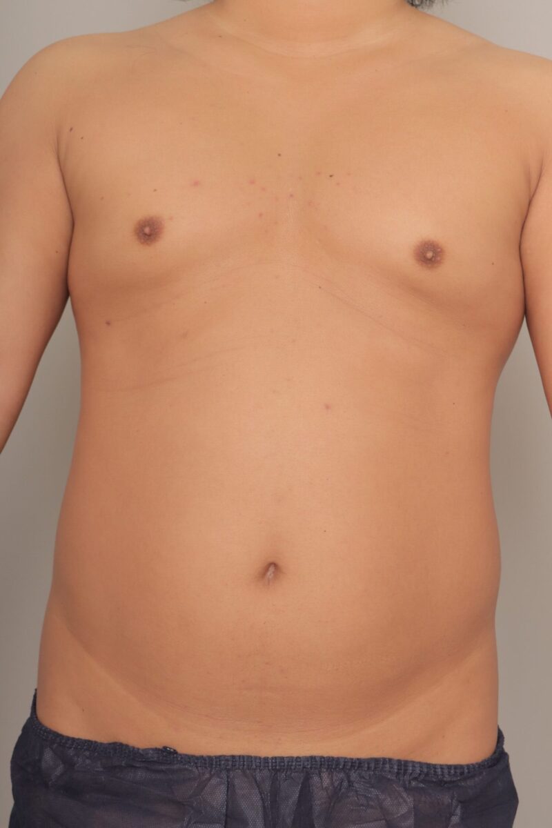 ベイザー脂肪吸引（６か月経過：30）の術前写真