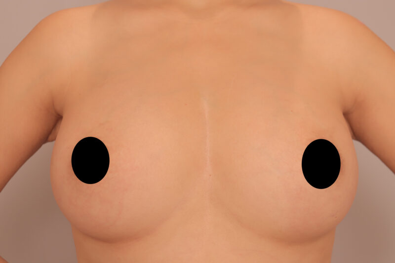 ベイザー脂肪吸引（1年半後経過：30）の術後写真