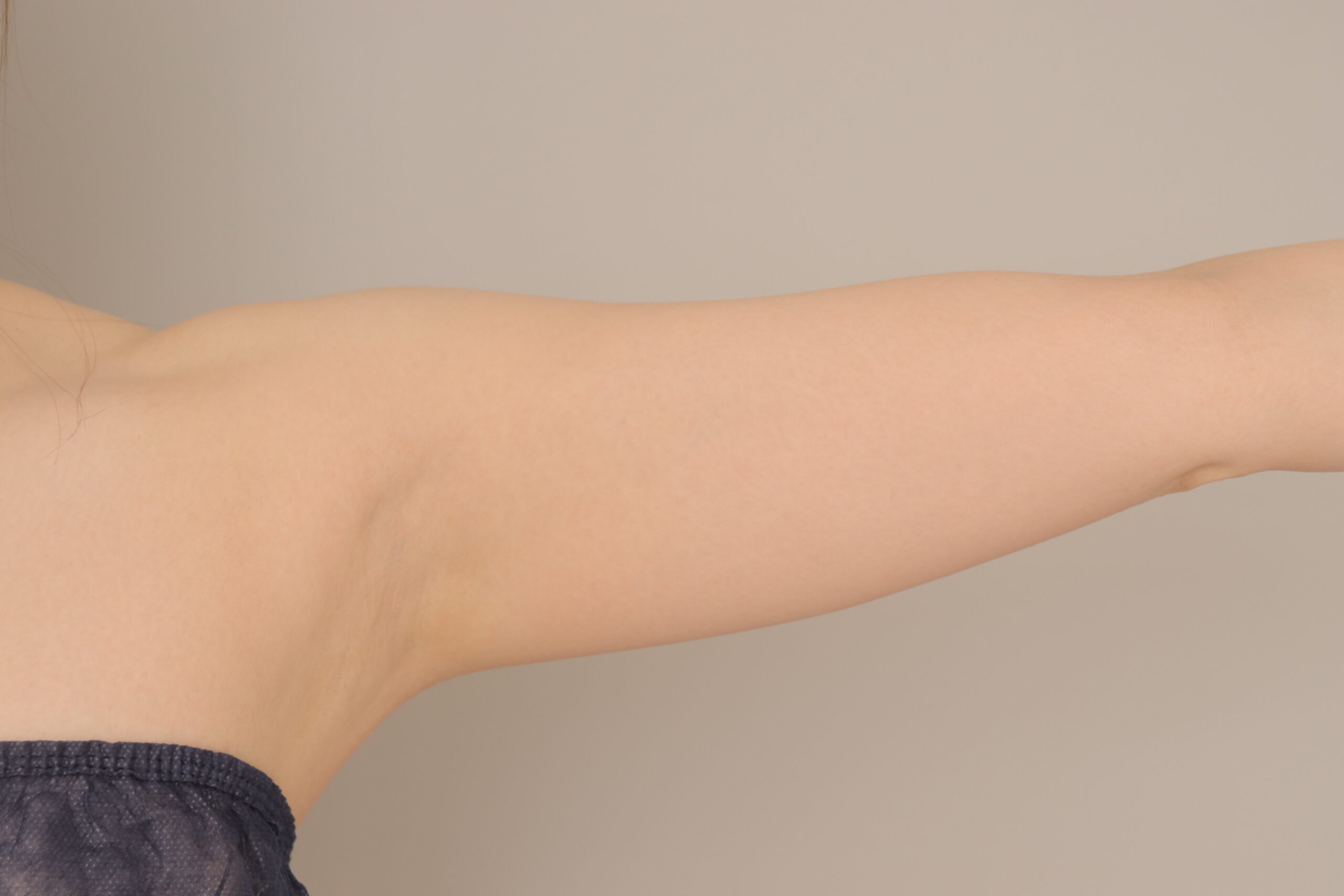 ベイザー脂肪吸引（1ヵ月経過：35）の術前写真