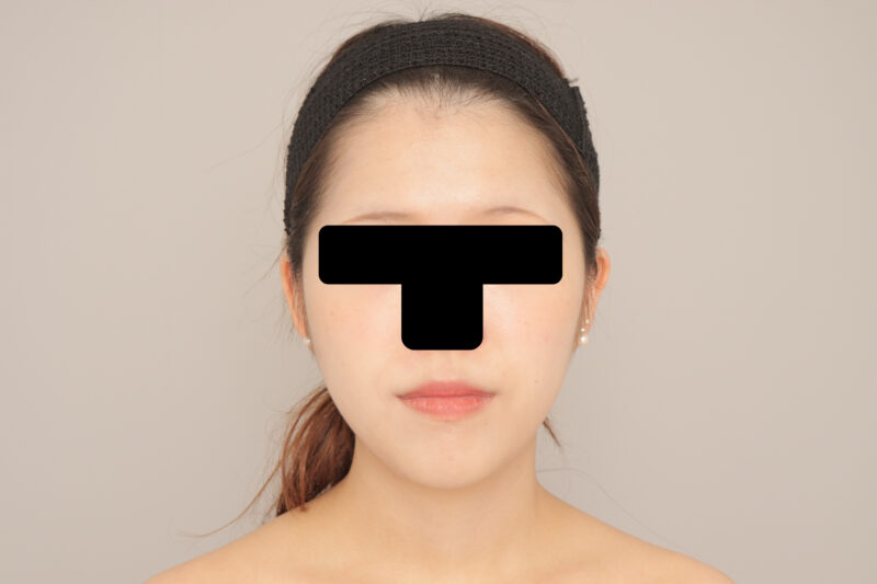 ベイザー脂肪吸引（3か月経過：25）の術後写真