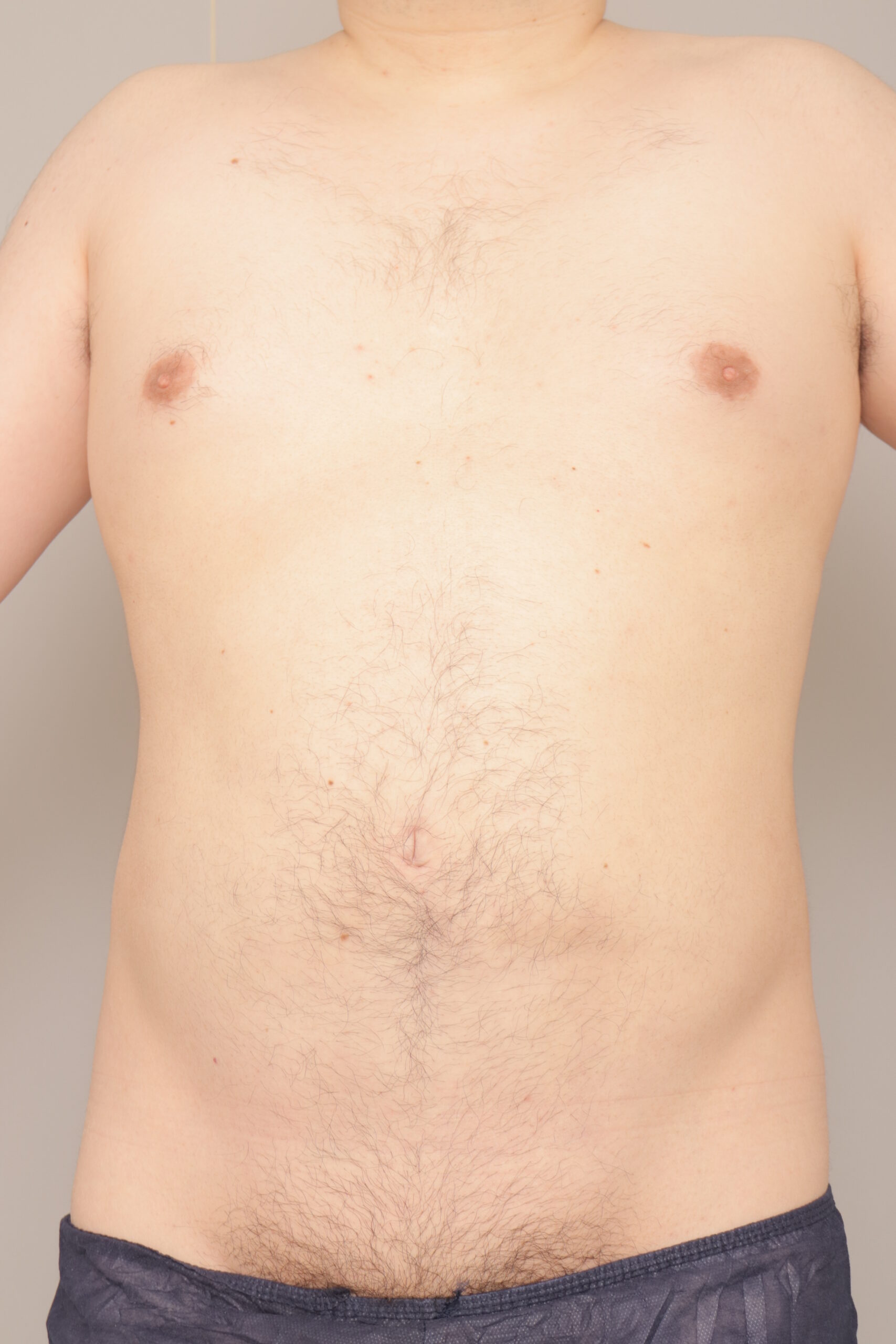 男性のお腹と腰の脂肪吸引も、効果抜群です。３か月経過。