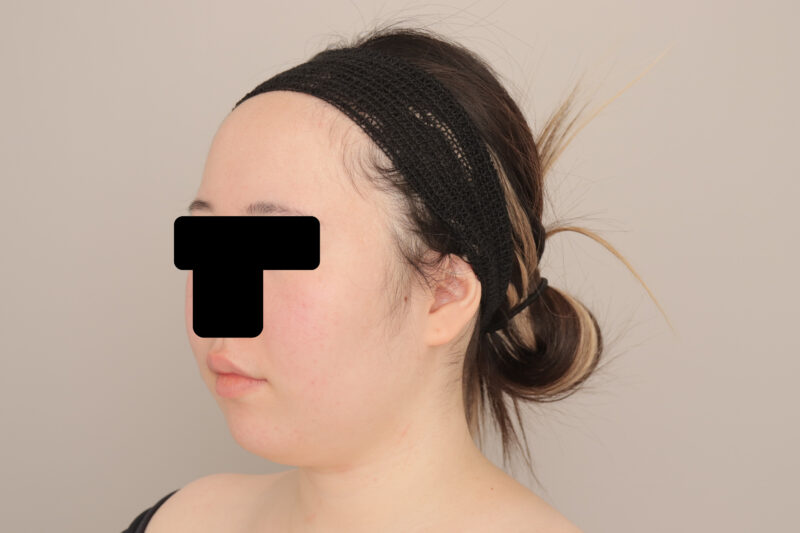 ベイザー脂肪吸引（１ヶ月経過：20）の術前写真