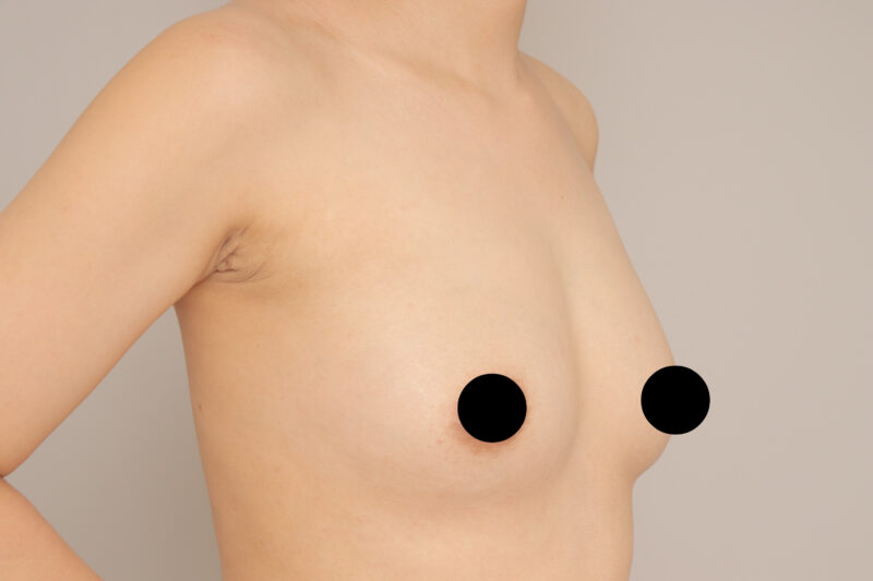 ベイザー脂肪吸引（１ヶ月経過：36）の術後写真